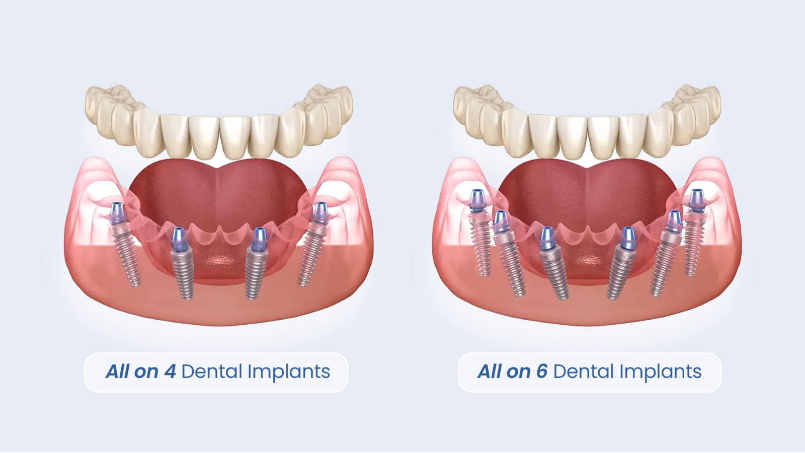 All-on-4 vs. All-on-6 Dental Implants