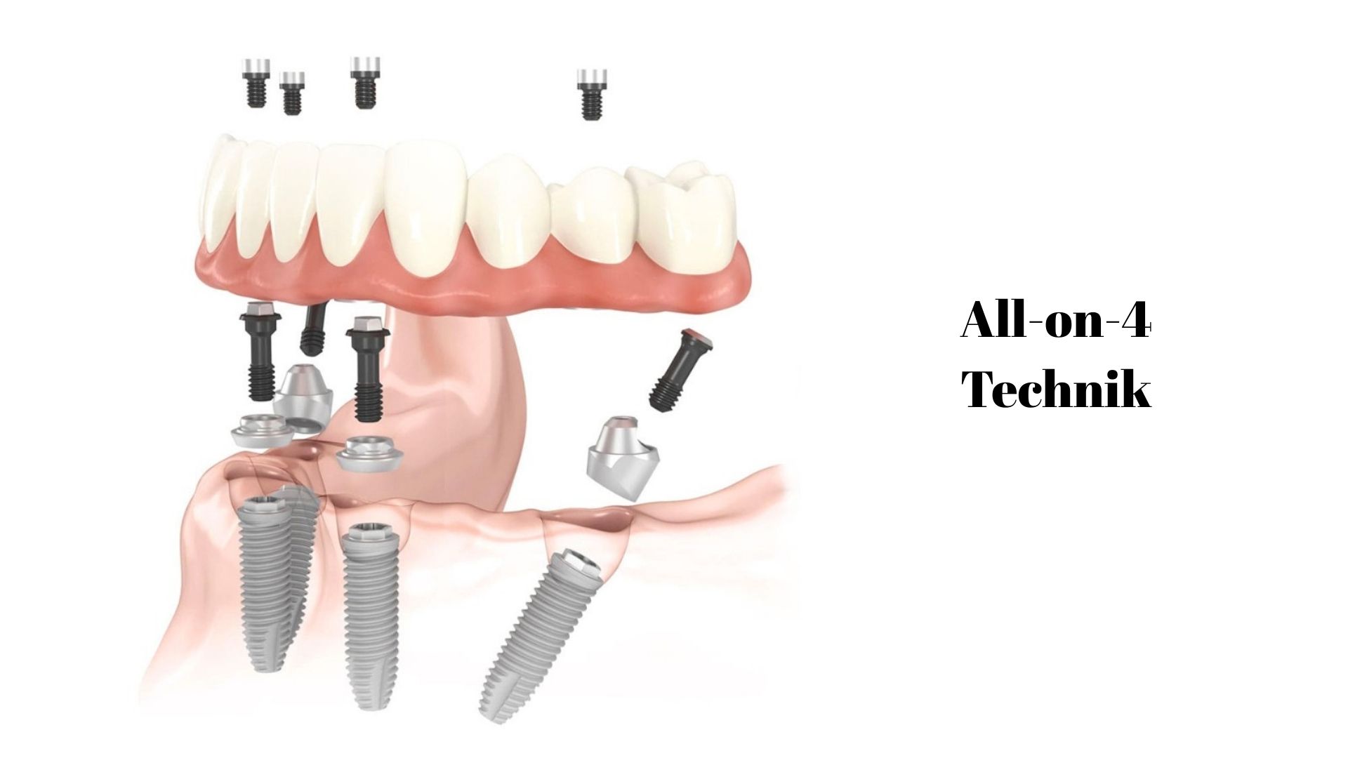 Was ist die All-on-4-Technik? 