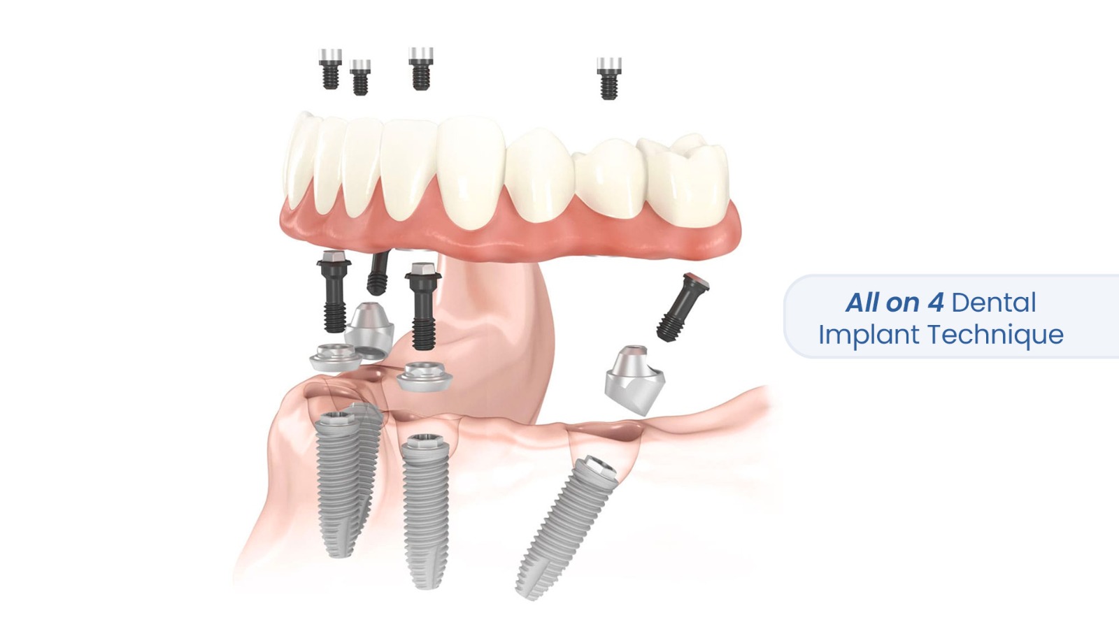 All-on-4 Dental Implants