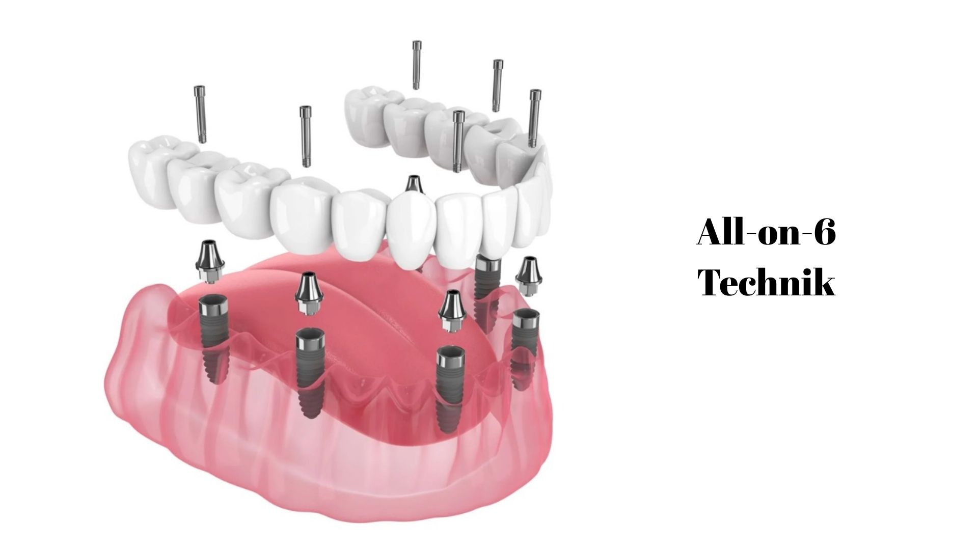 Was ist die All-on-6-Technik? 