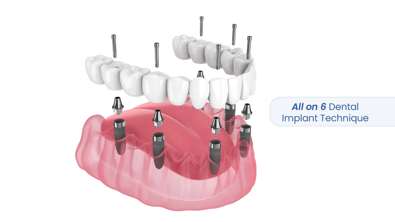 All-on-6 Dental Implants