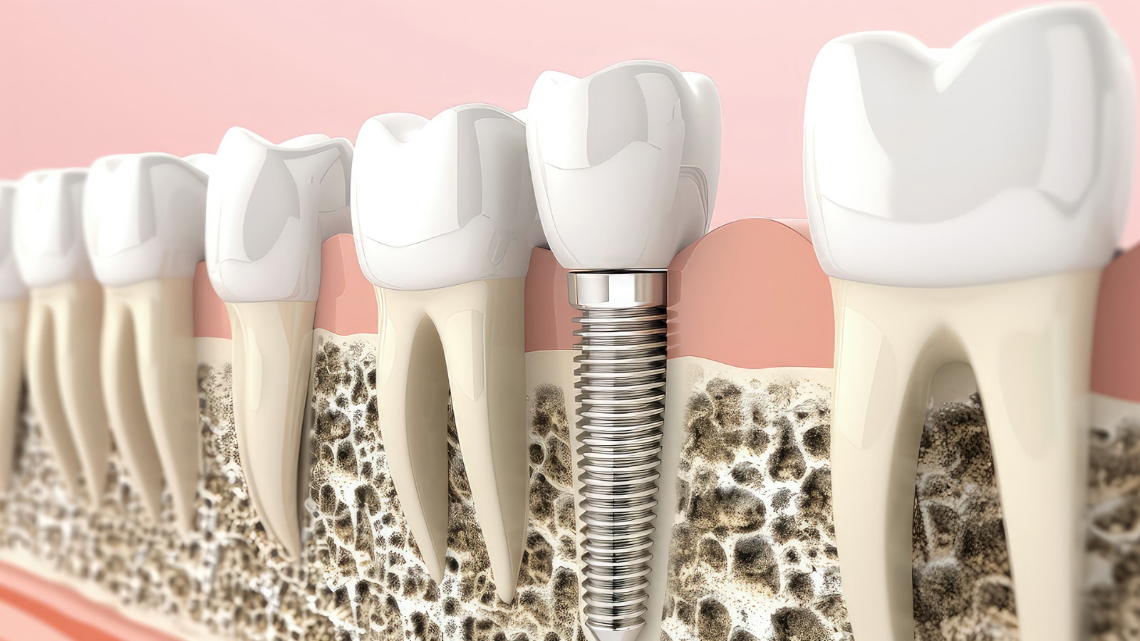 Main Difference Between All-on-4 and All-on-6