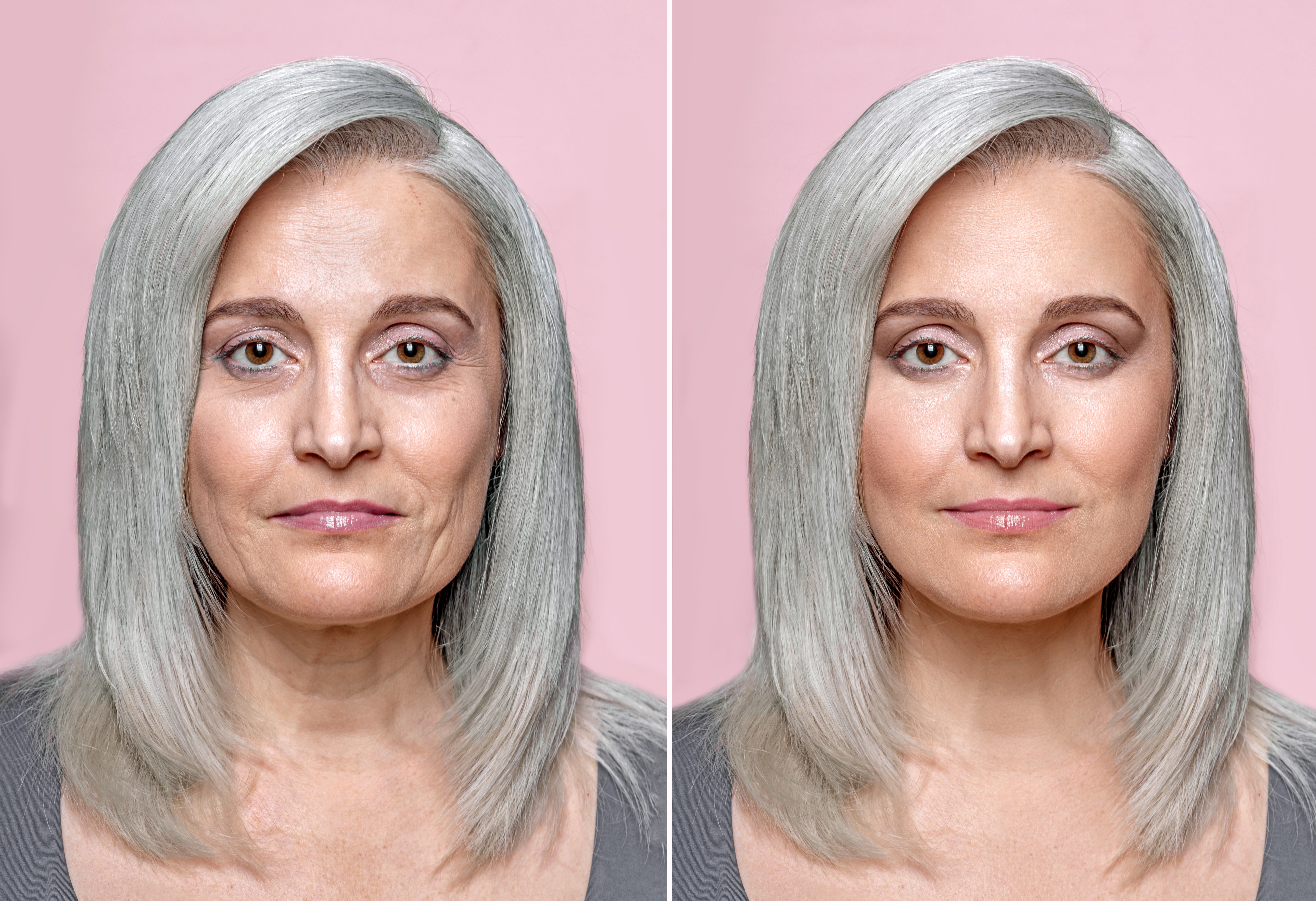 Deep Plane Facelift in Turkey before and after-1