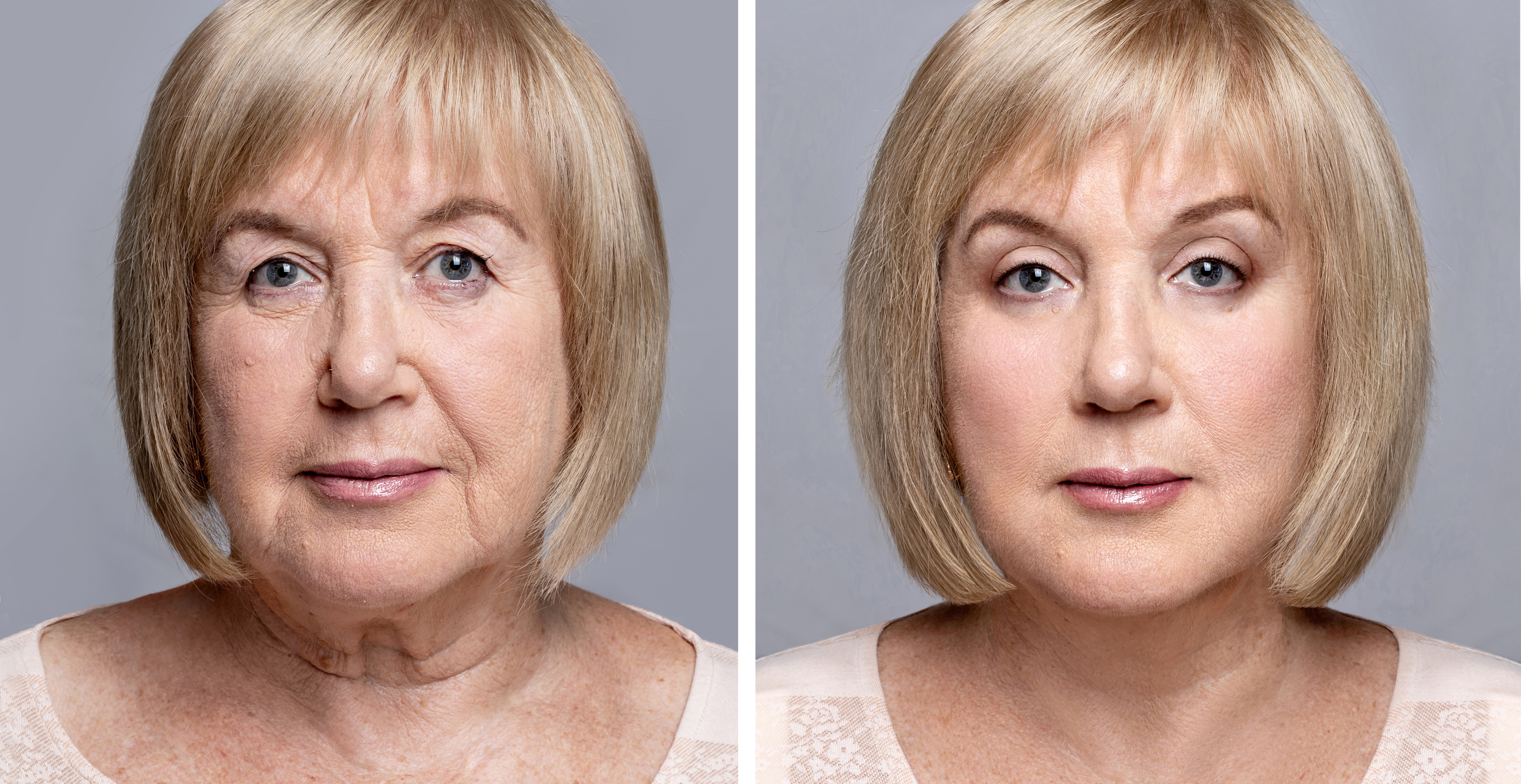 Deep Plane Facelift in Turkey before and after-2