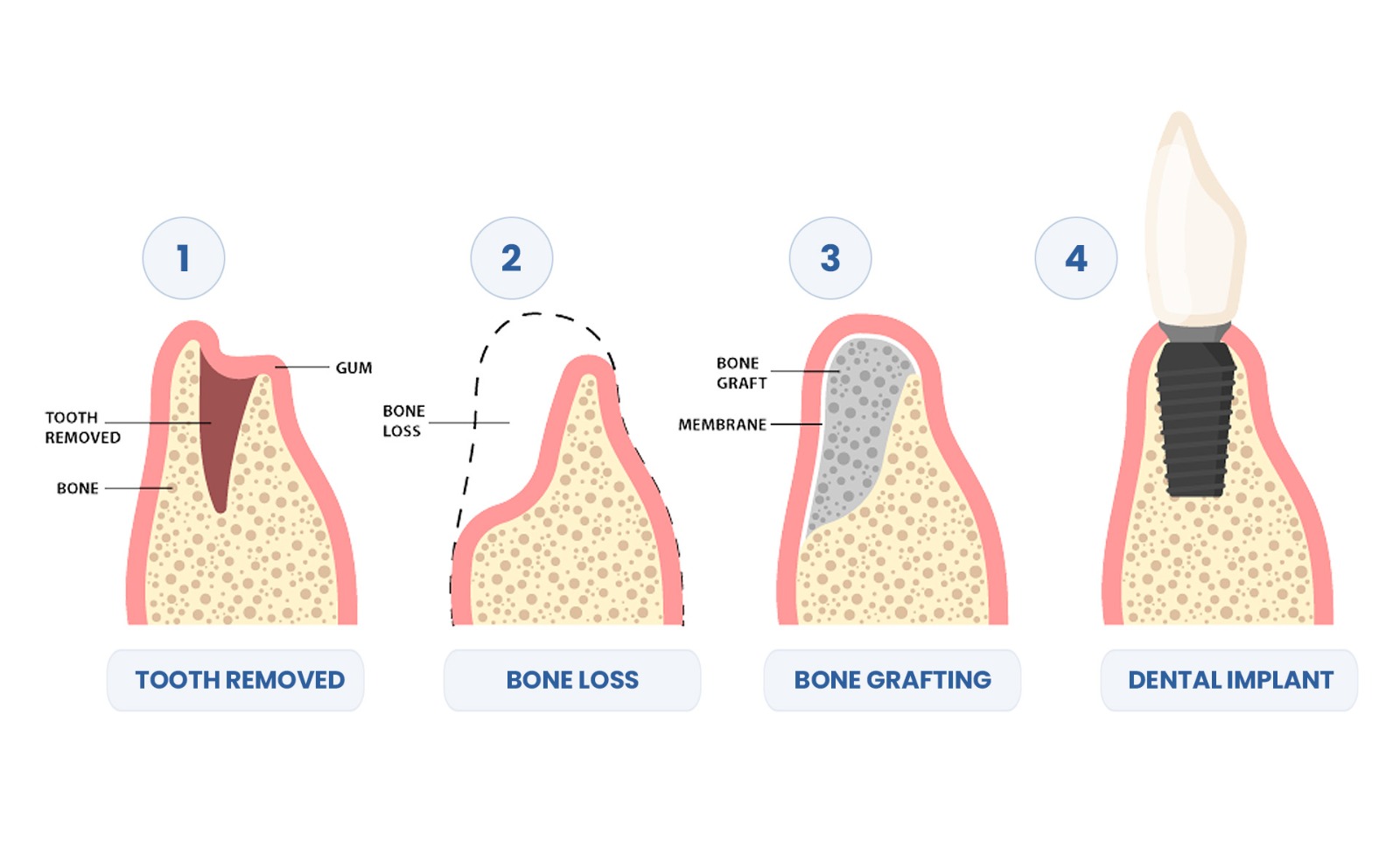 Dental Bone Grafting Procedure