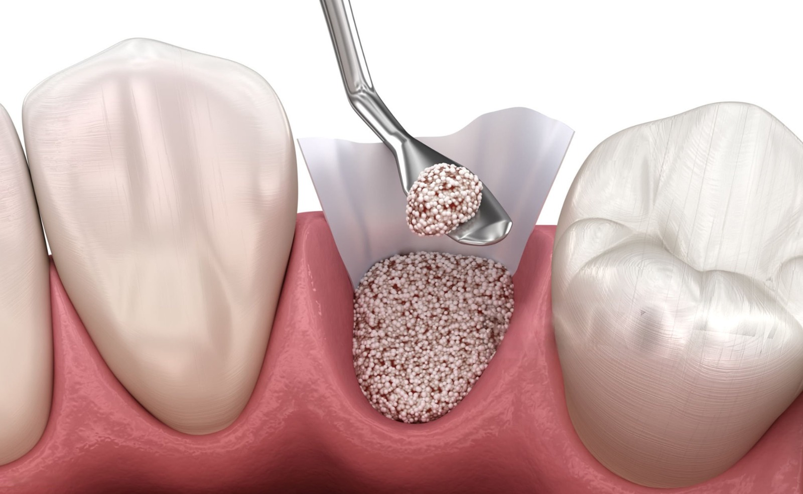Insufficient Bone for Dental Implants