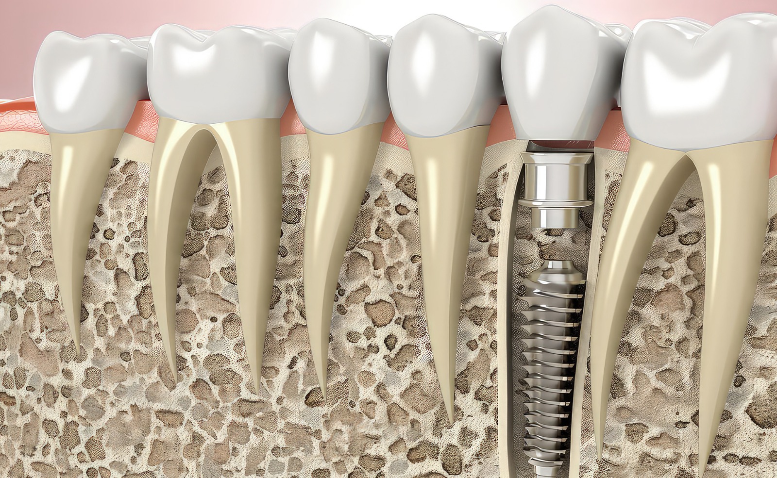 the Benefits of a Dental Bone Graft 