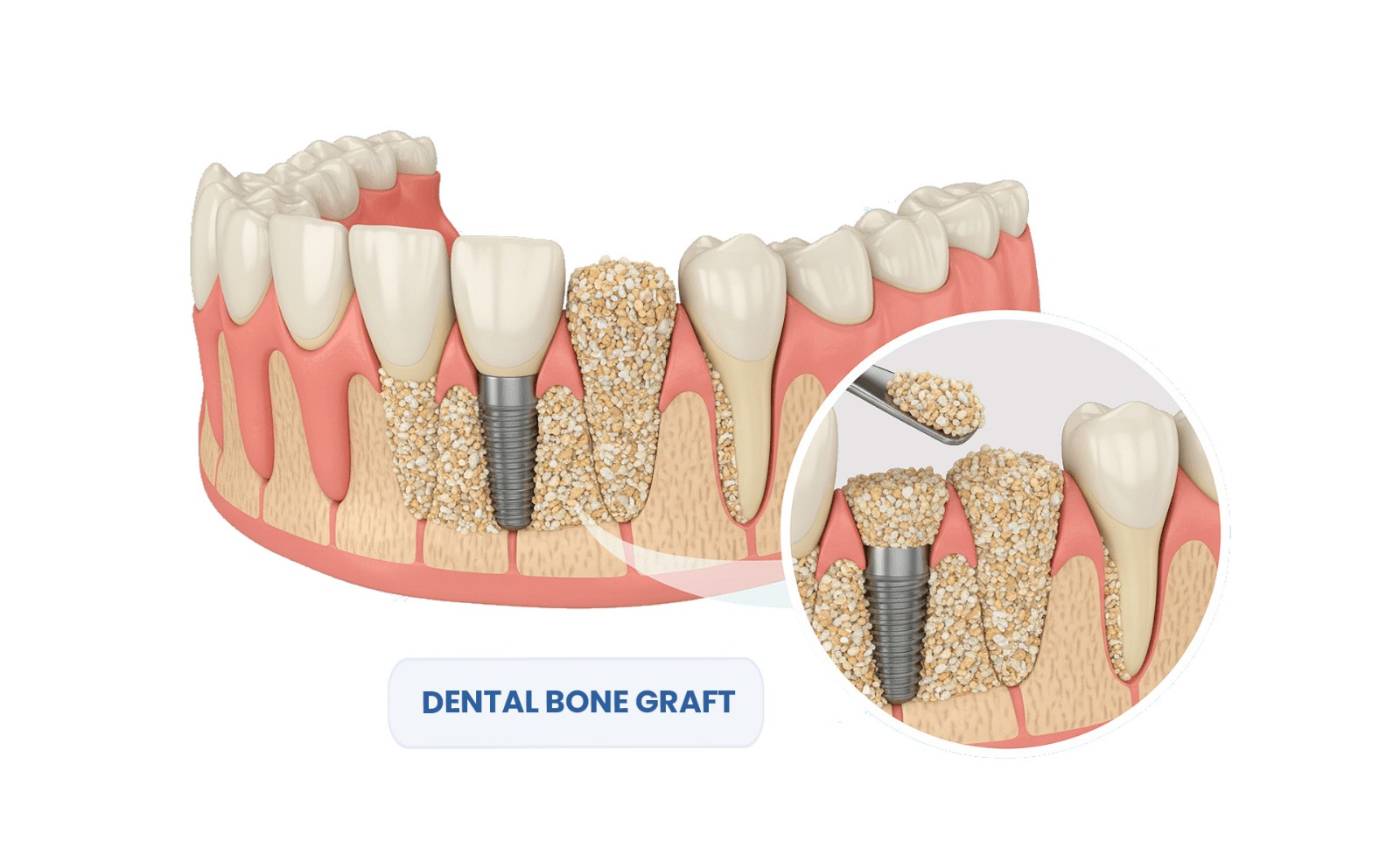 Dental Bone Graft