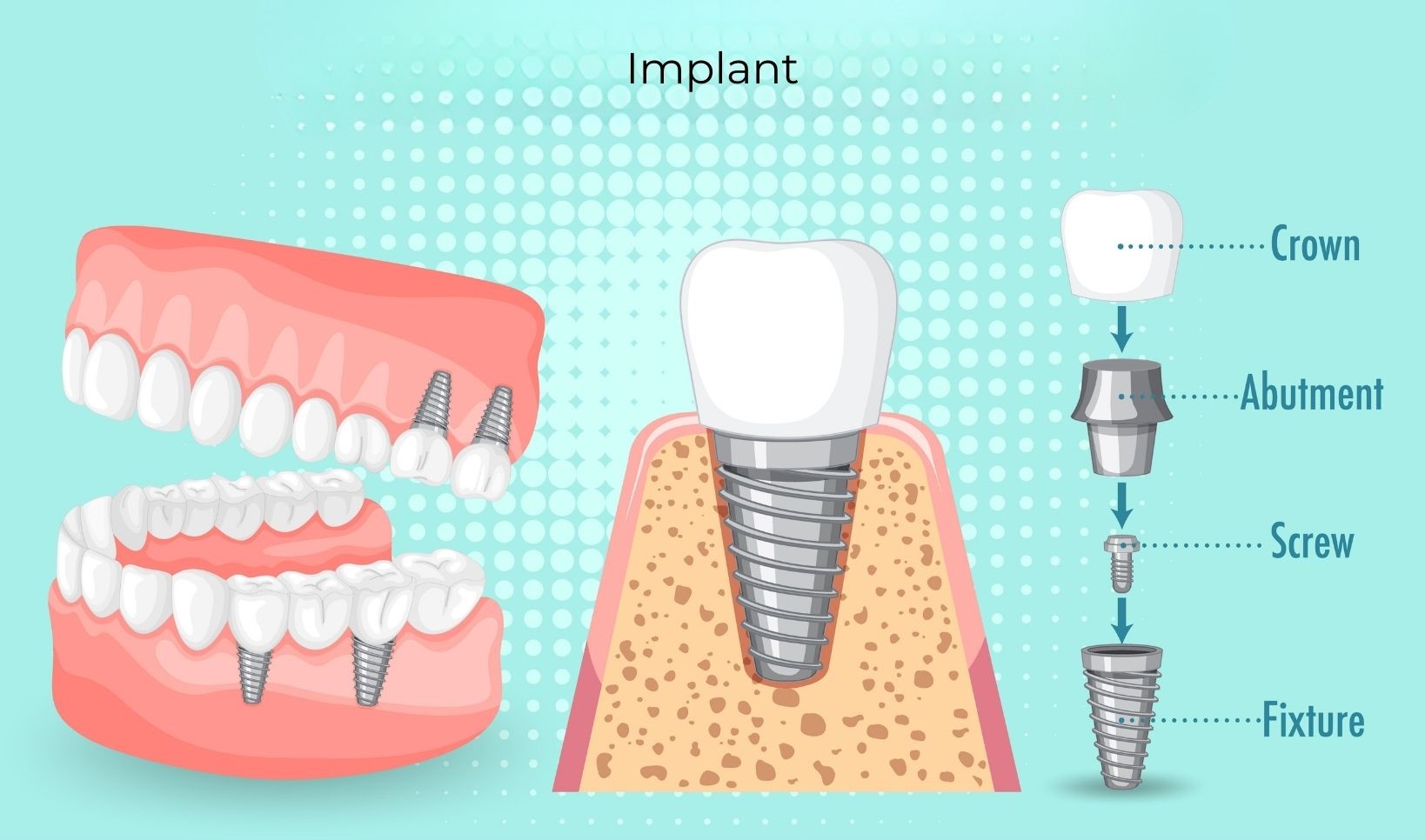 Dental Implant 