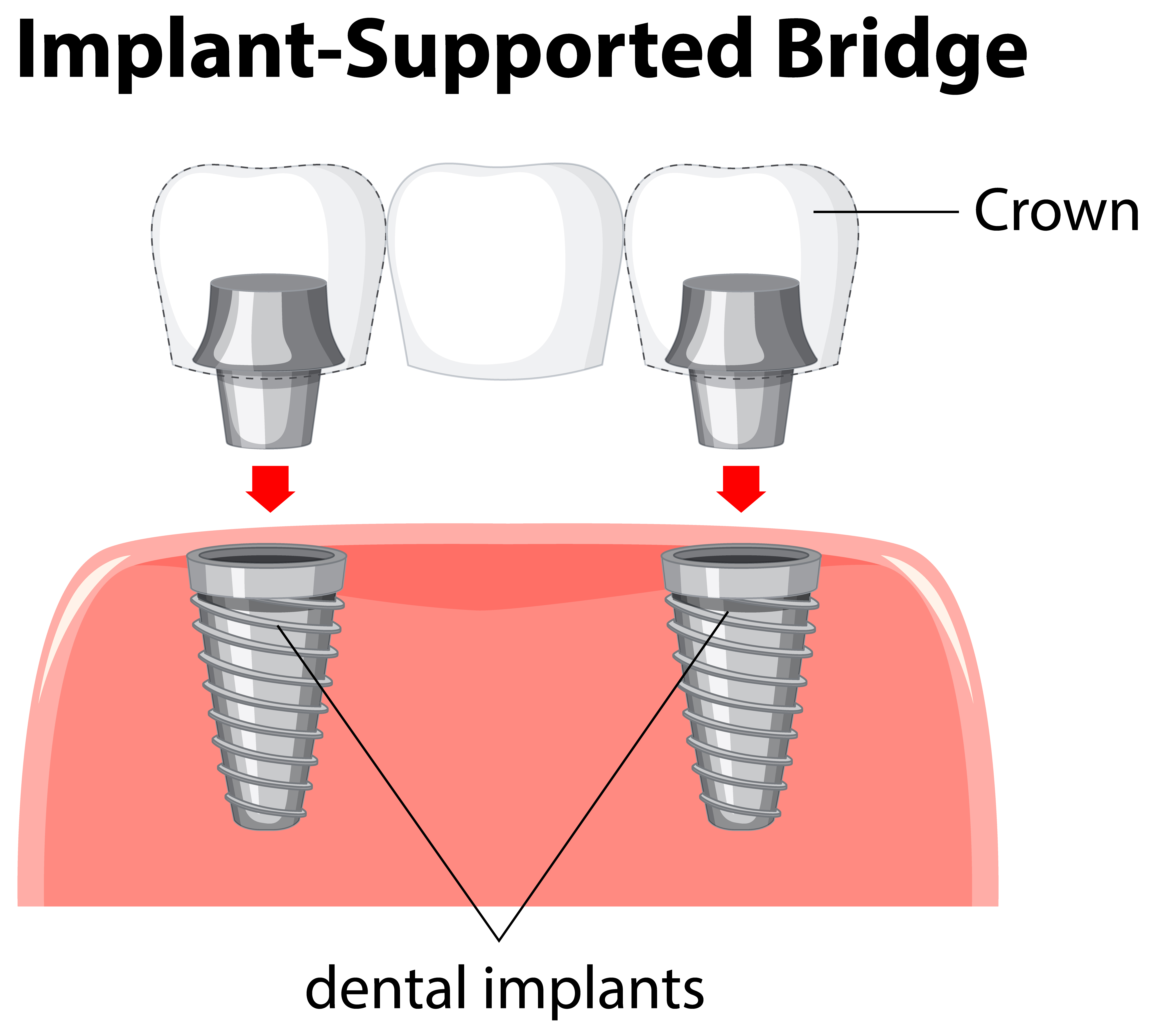 Implant-supported bridges 