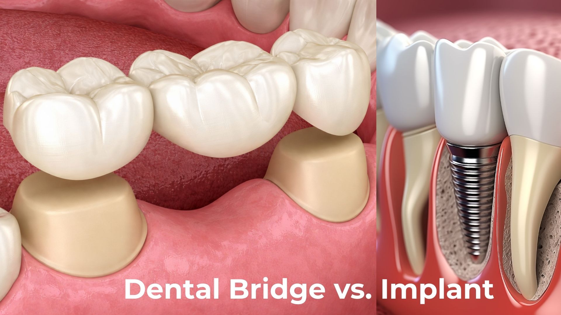 dental-bridge-vs-implant