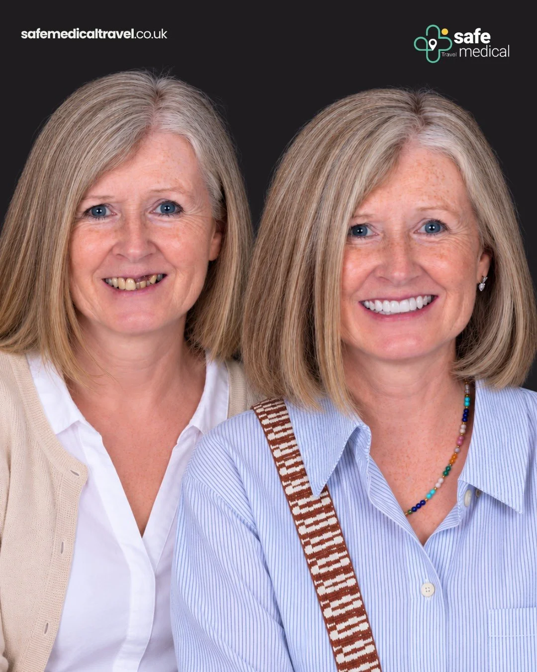 Angela before and after dental implant treatment in Turkey