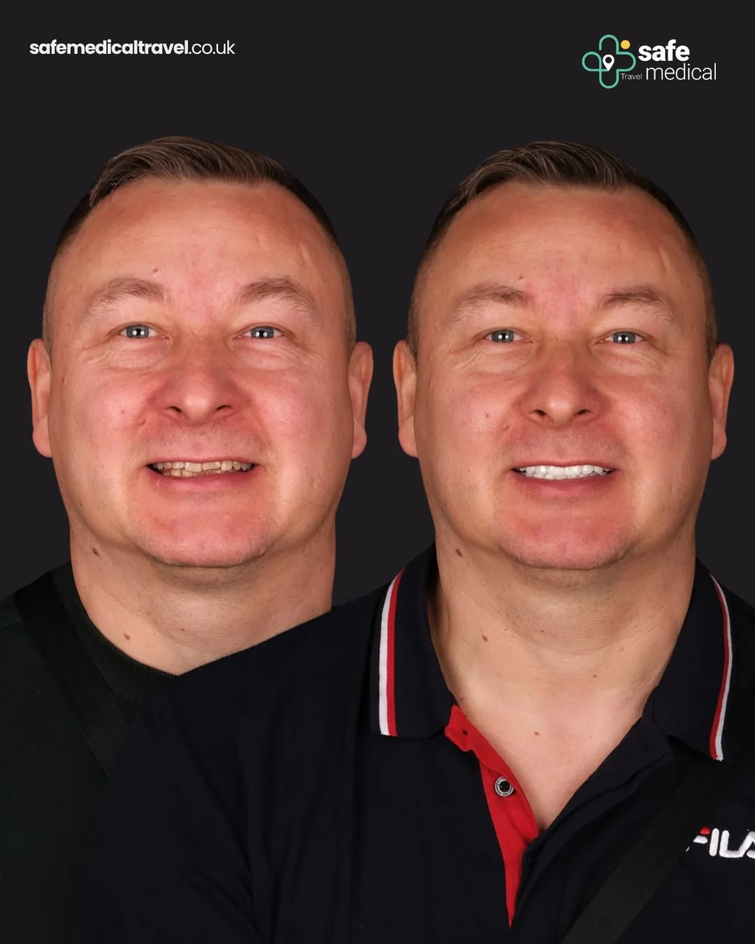 Radoslaw before and after dental implant treatment with zirconium crowns in Turkey