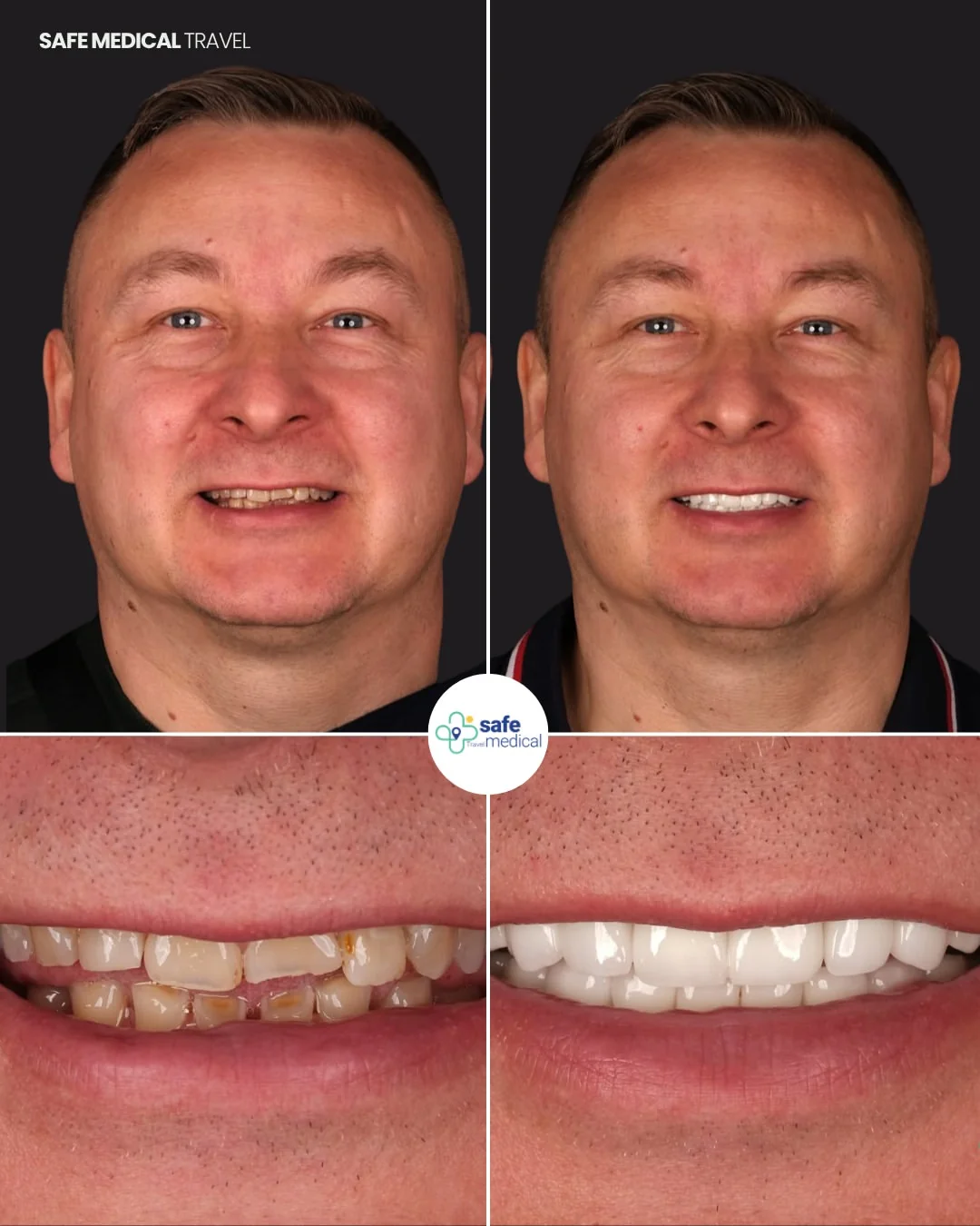 Dental implants and zirconium crowns before and after: face and smile comparison