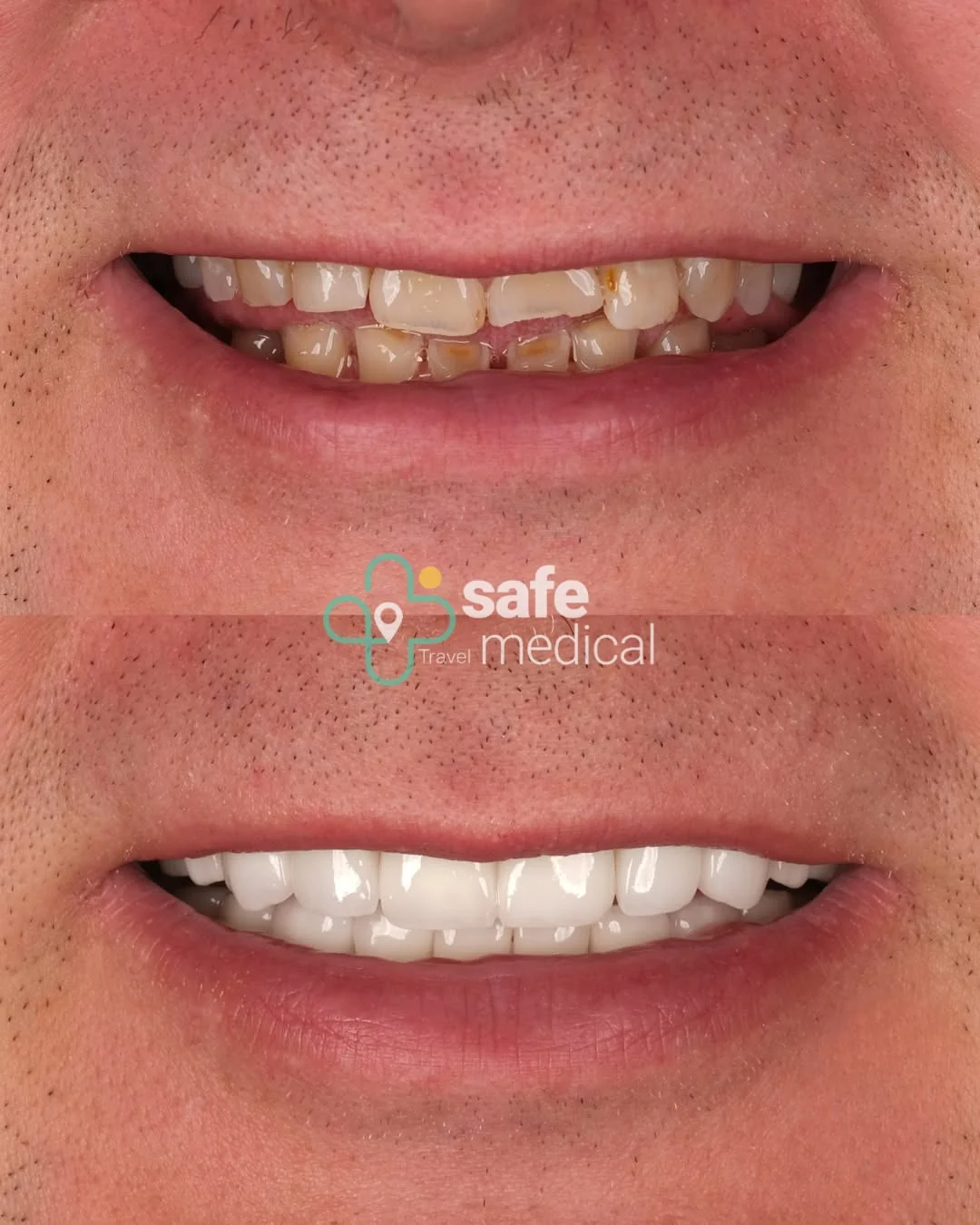 Close-up of teeth before and after dental implants and zirconium crowns in Turkey
