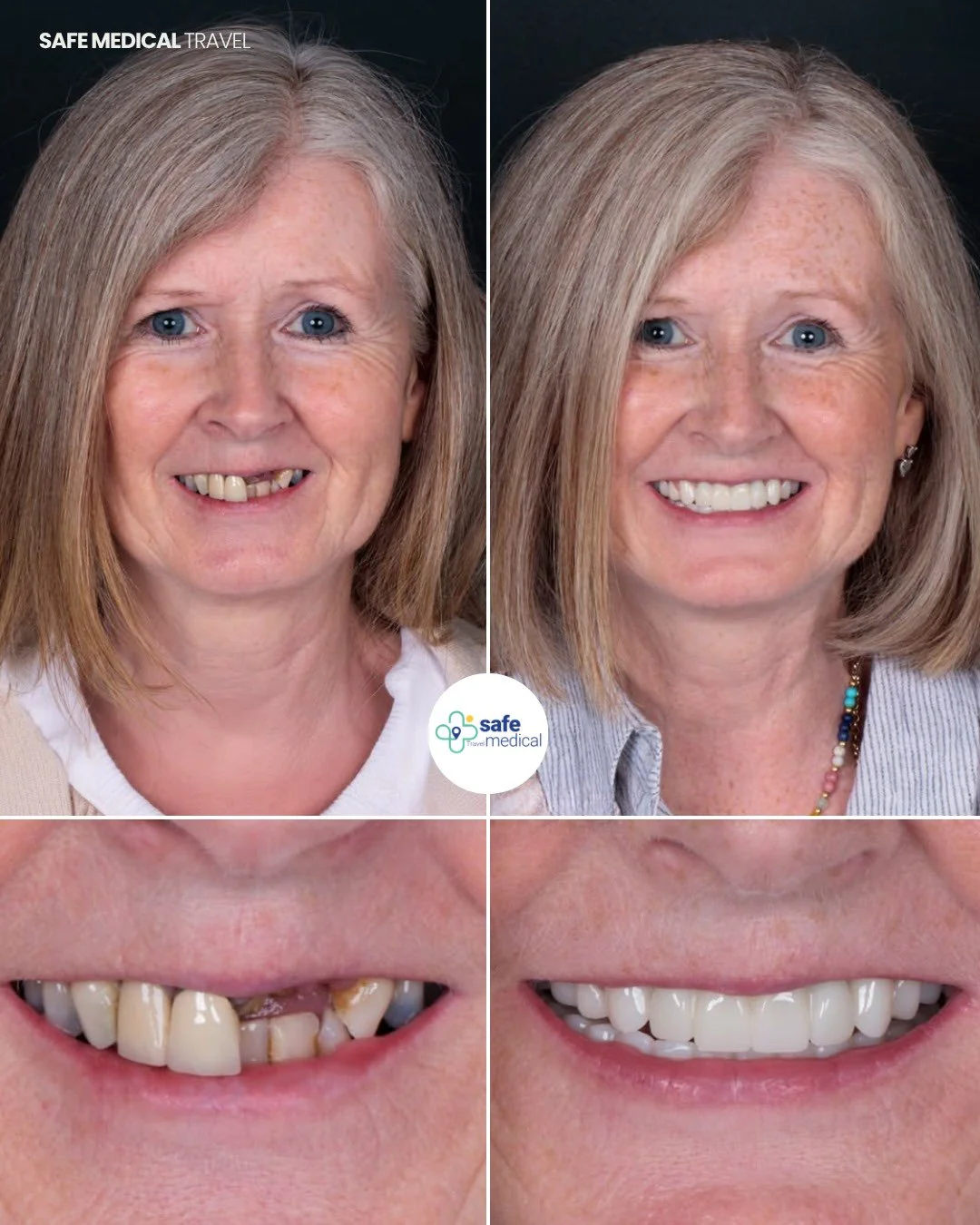 Dental implant treatment before and after: face and smile comparison