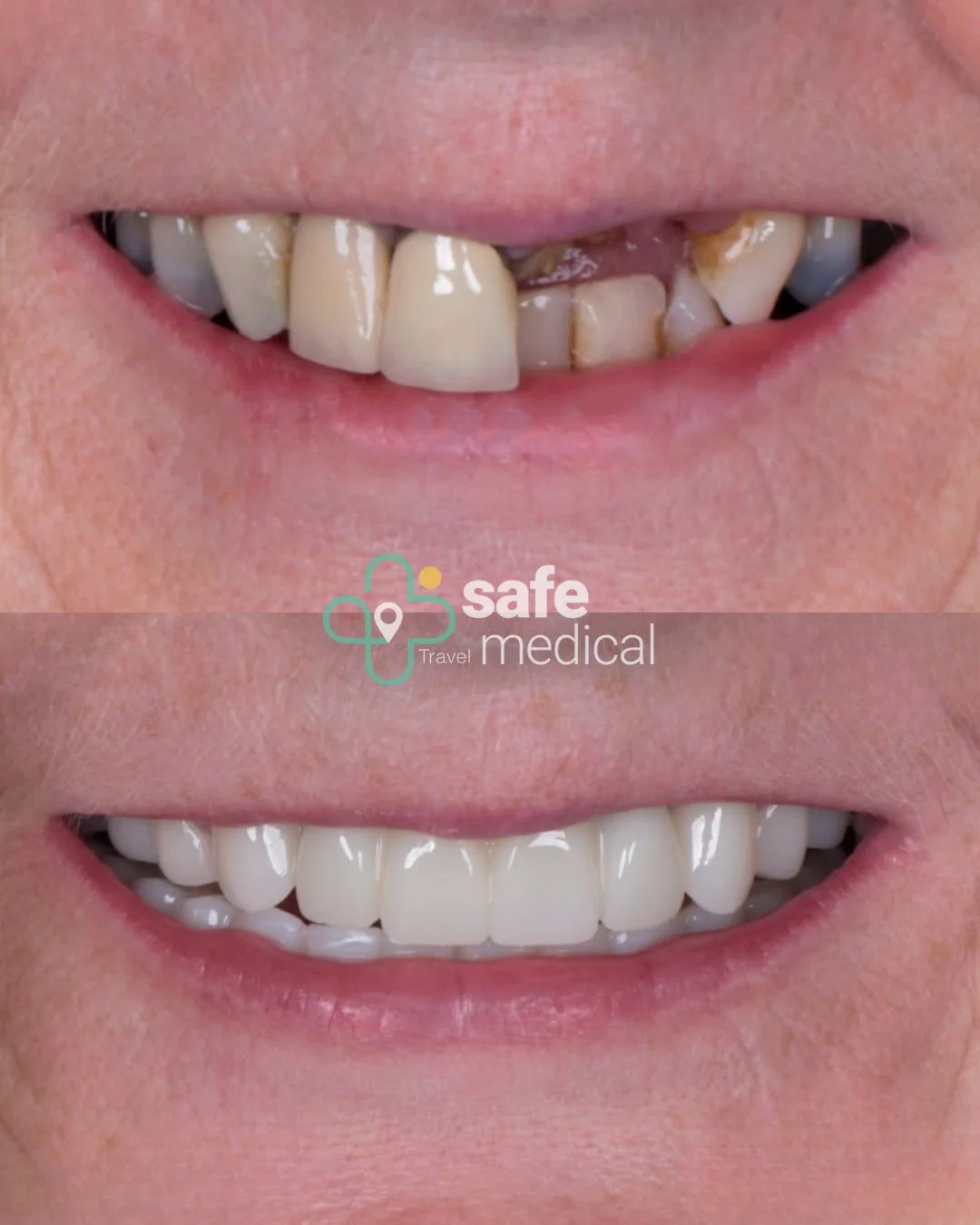 Close-up of teeth before and after dental implant treatment in Turkey