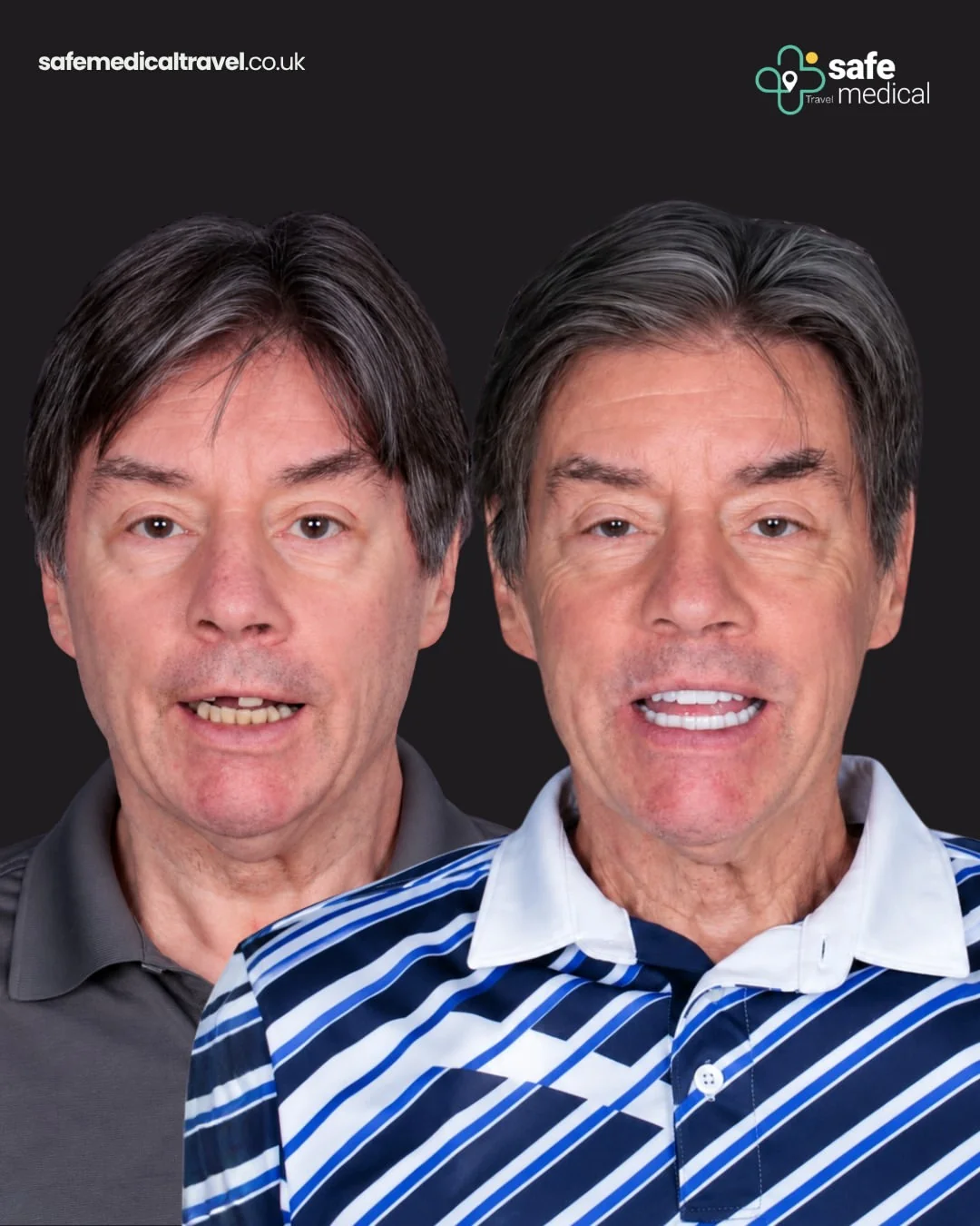 Tom before and after All-on-6 dental implant treatment in Turkey