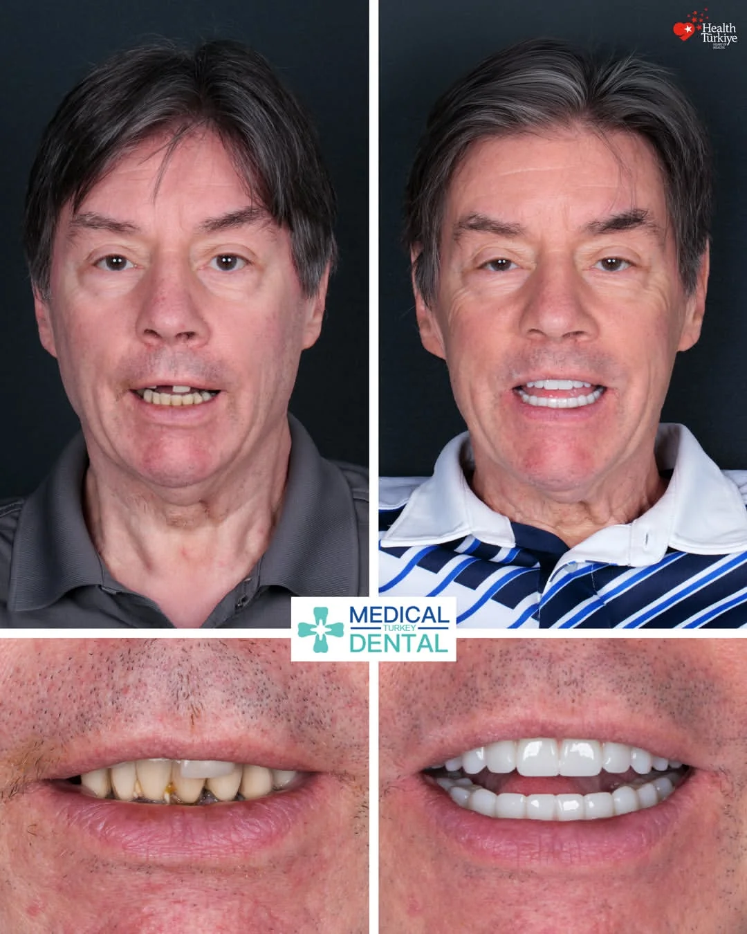 All-on-6 before and after: face and smile comparison