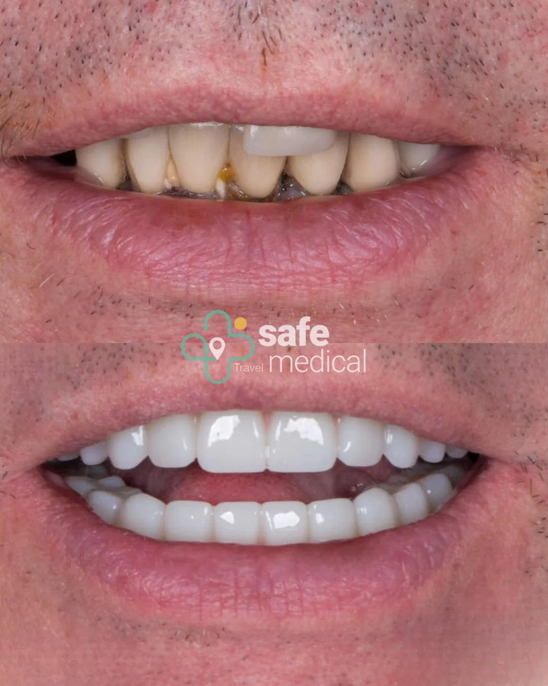 Close-up of teeth before and after All-on-6 treatment in Turkey