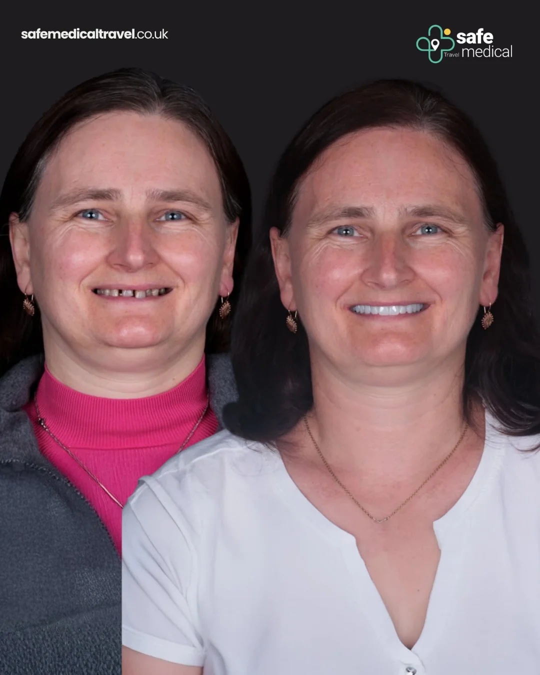 Renata before and after All-on-4 dental implant treatment in Turkey