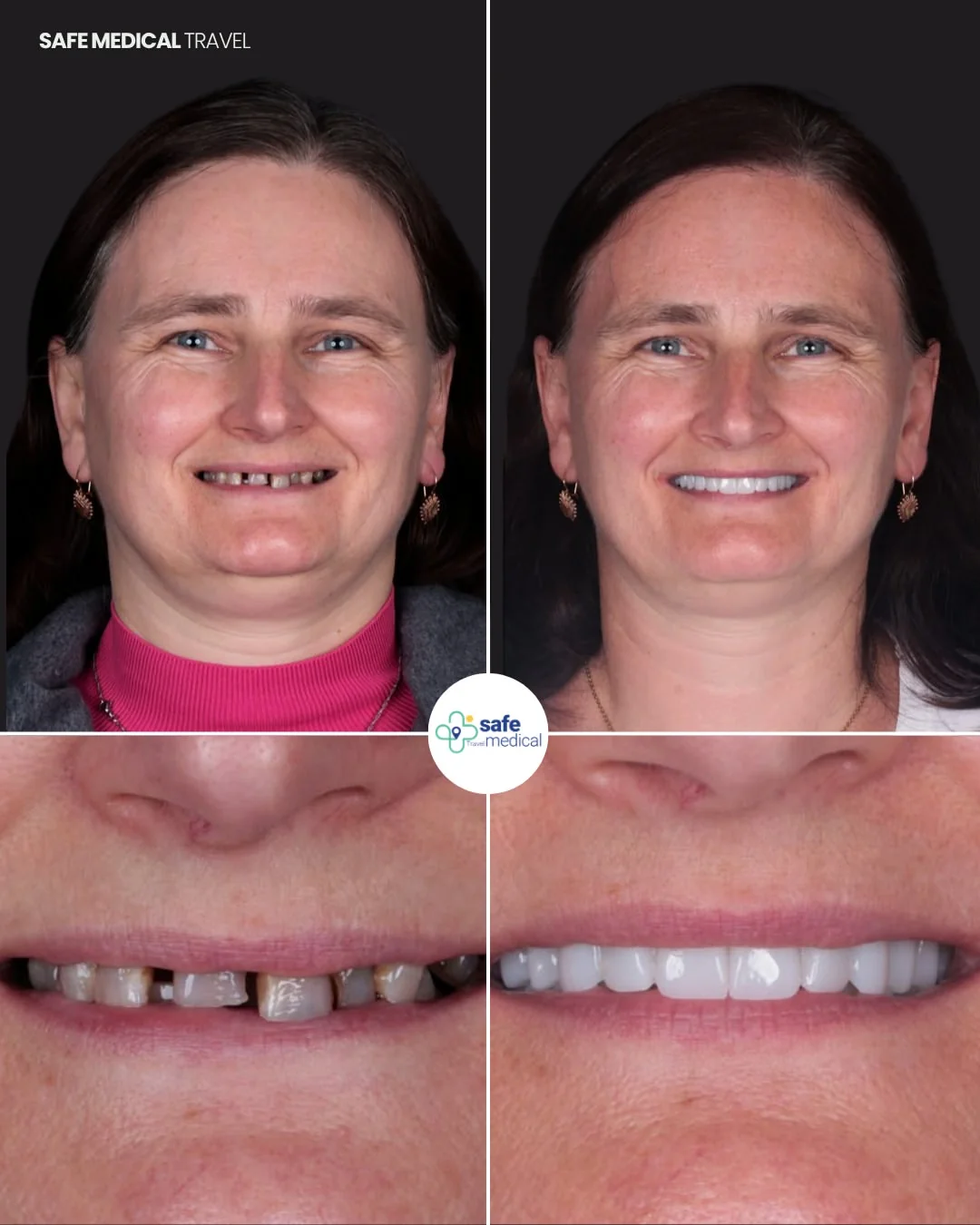 All-on-4 before and after: face and smile comparison