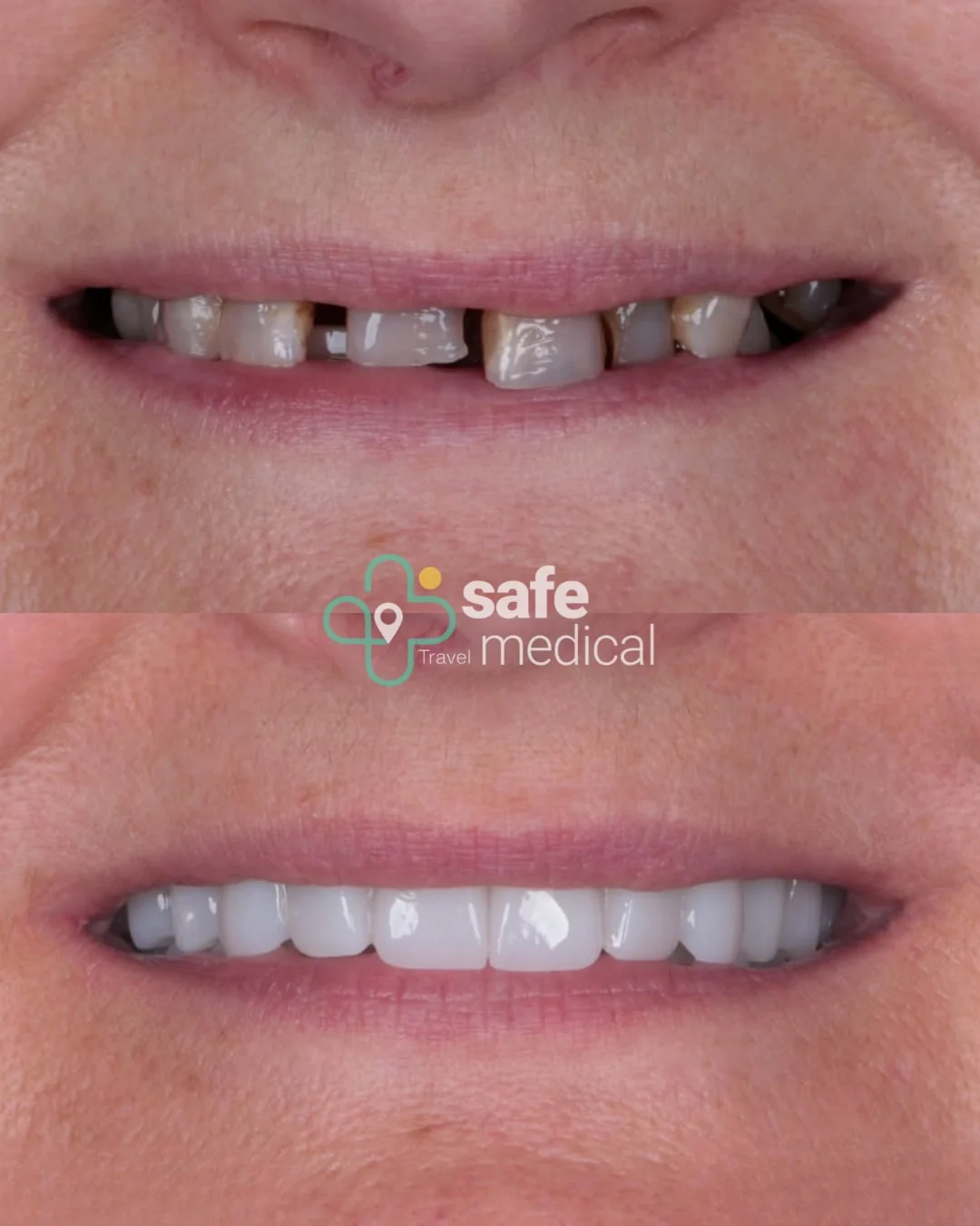 Close-up of teeth before and after All-on-4 treatment in Turkey