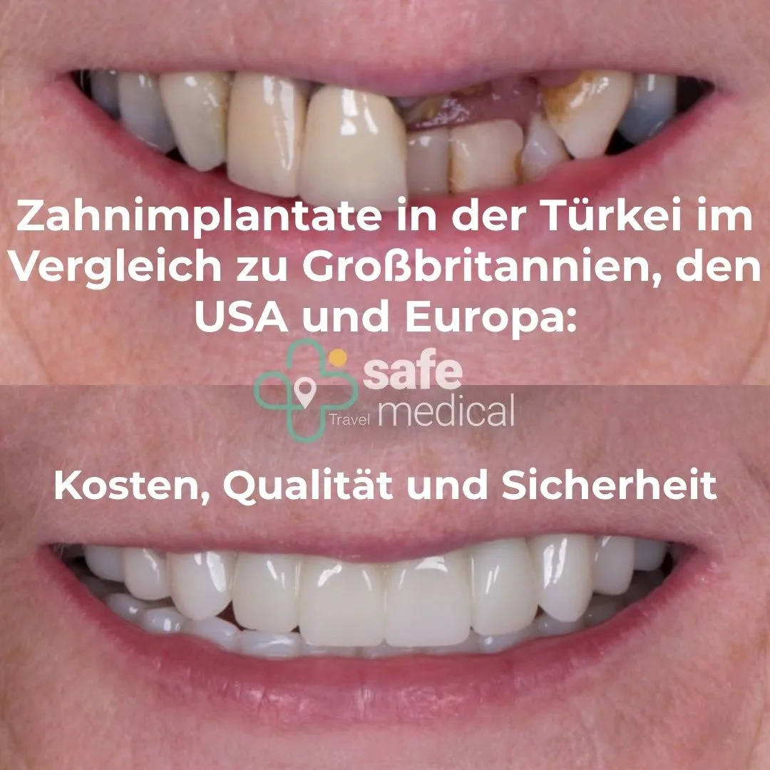 Zahnimplantate in der Türkei vs. Großbritannien, USA und Europa