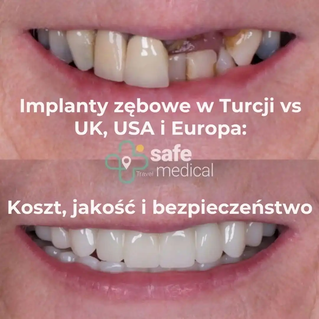 Implanty zębowe w Turcji a Wielka Brytania, USA i Europa