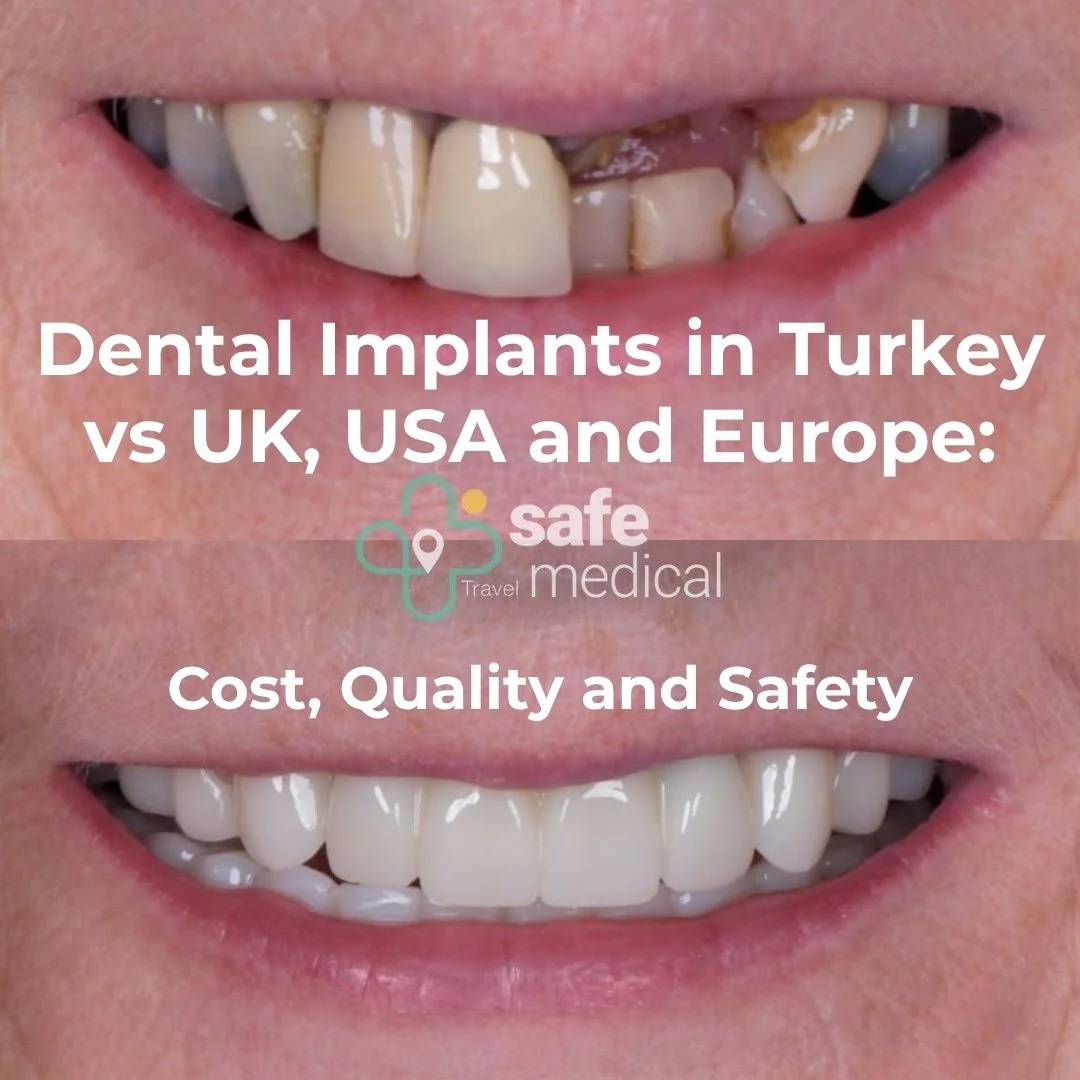 Dental Implants in Turkey vs UK, USA and Europe