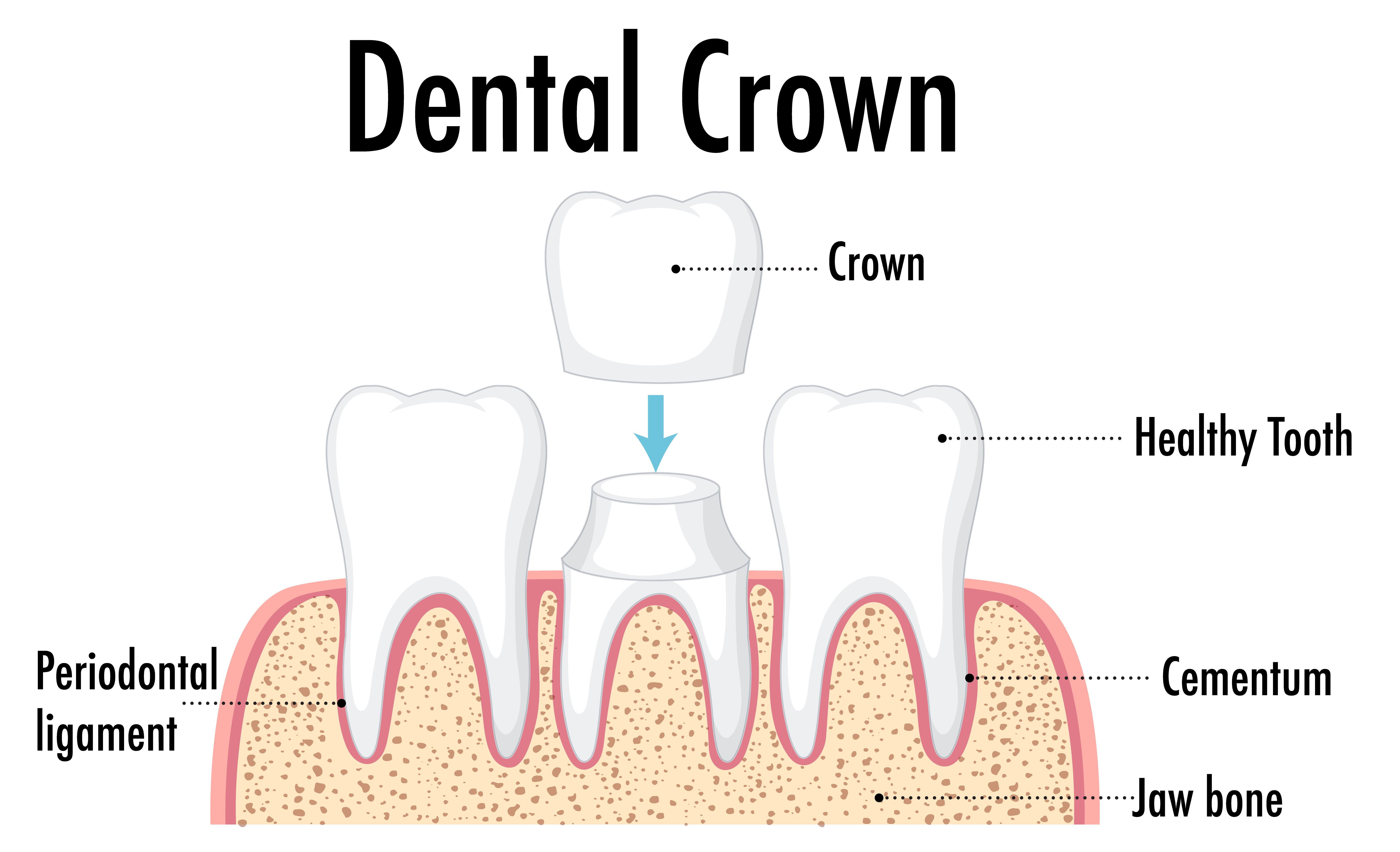 Dental crown 