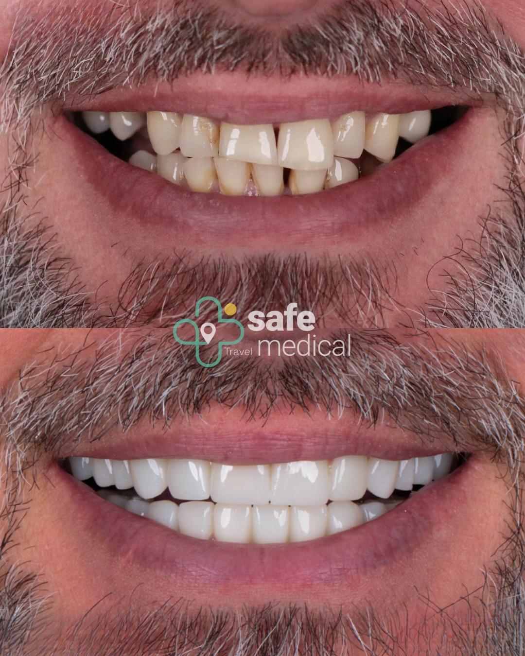 dental-veneers-turkey before and after-1