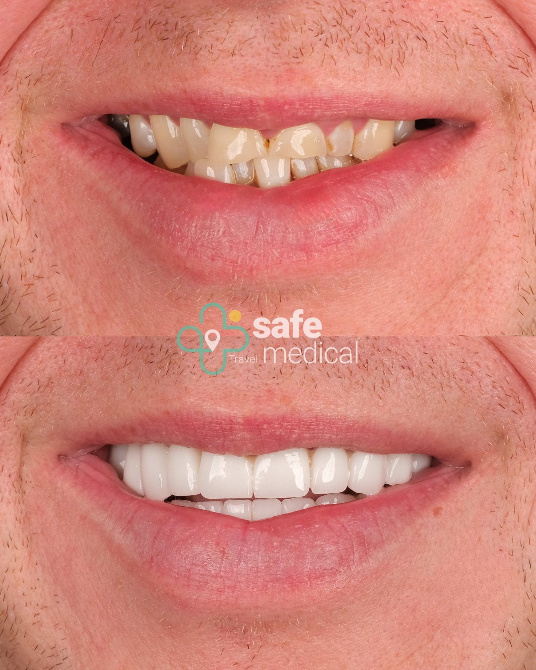 dental-veneers-turkey before and after-2
