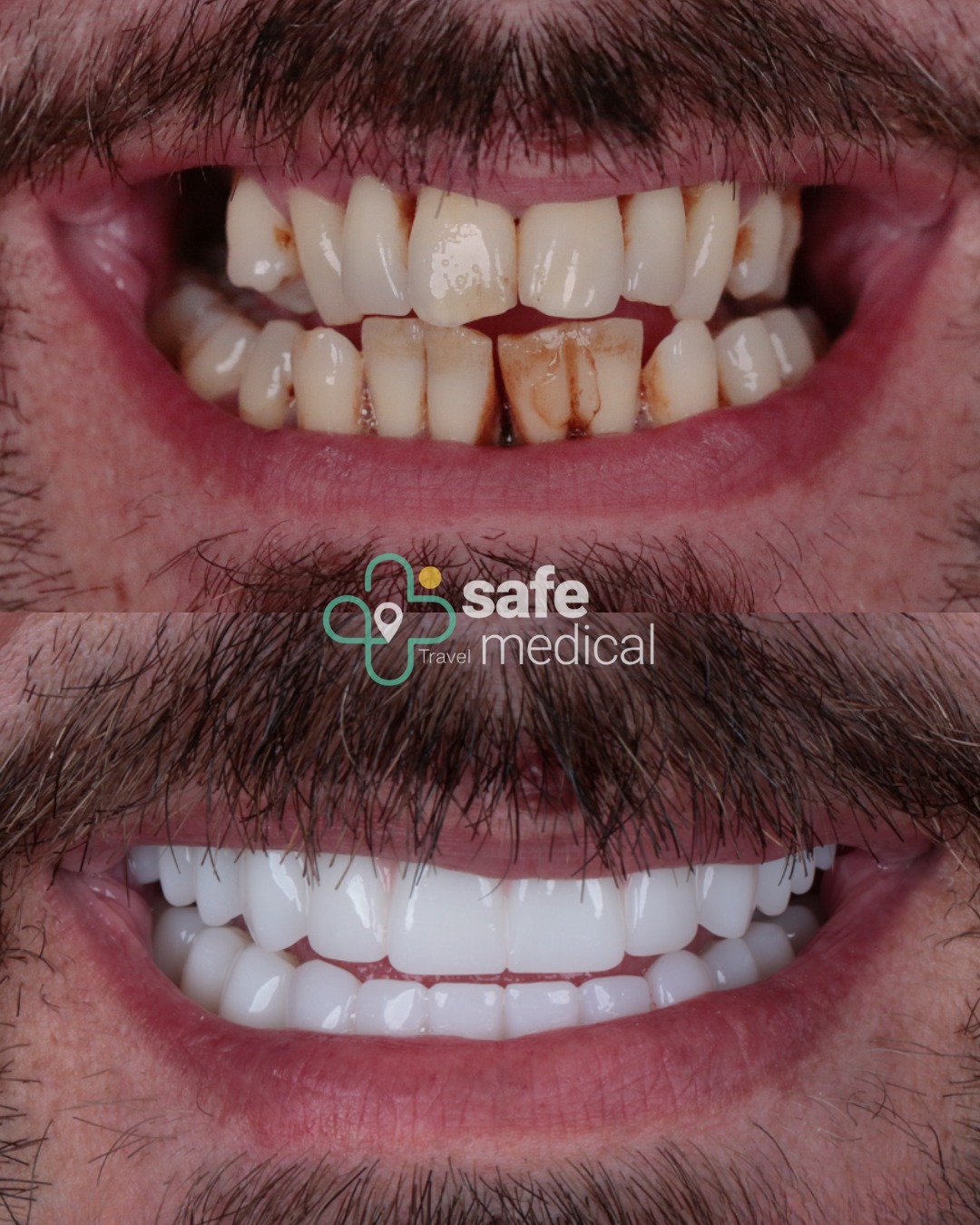 dental-veneers-turkey before and after-3