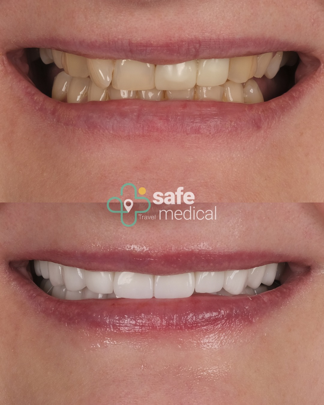 dental-veneers-turkey before and after-4