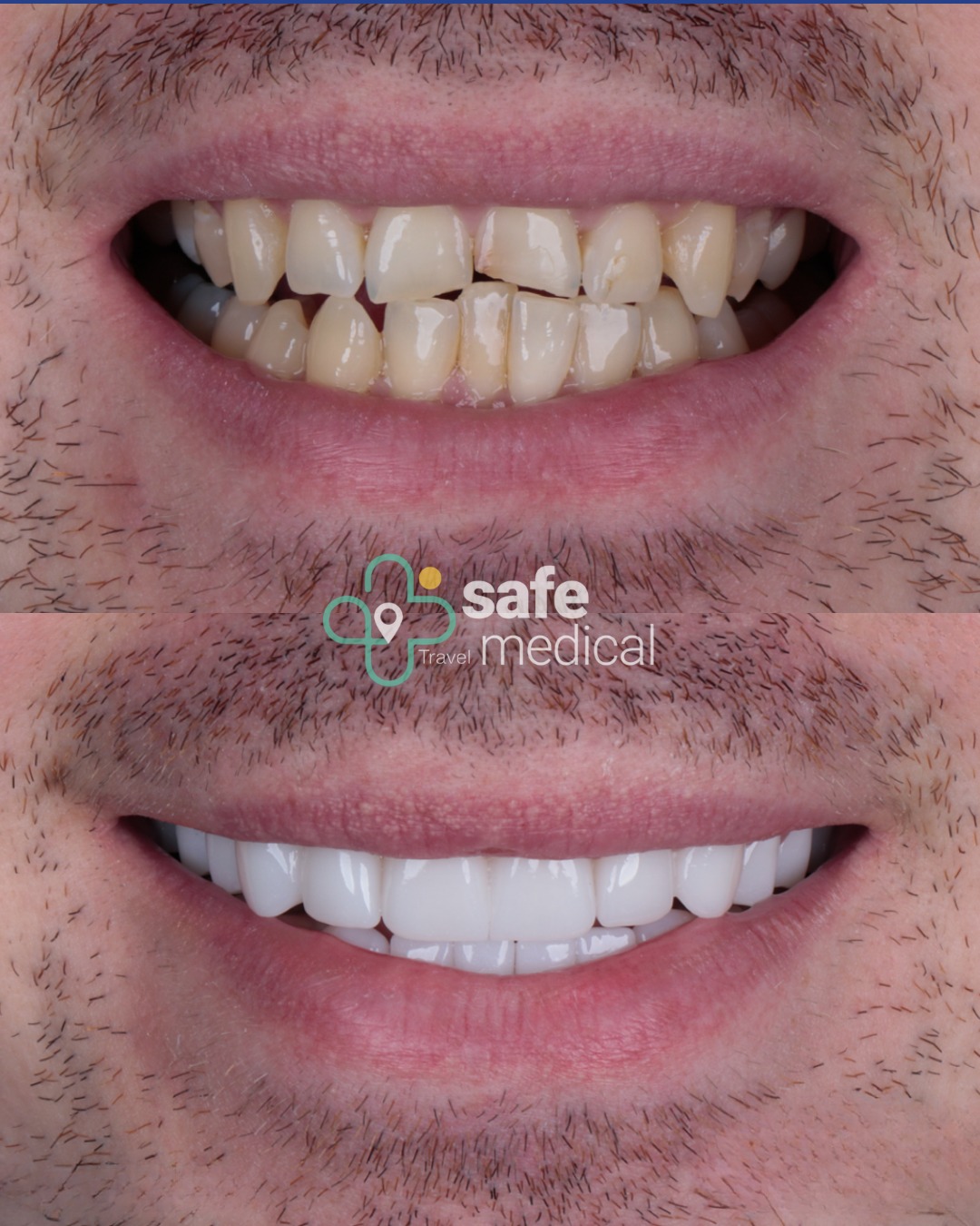 dental-veneers-turkey before and after-6
