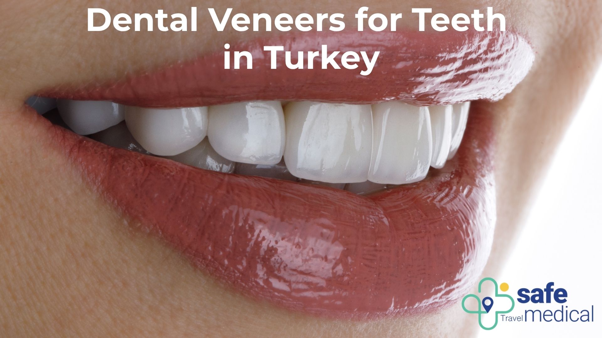 Dental Veneer For Teeth 
