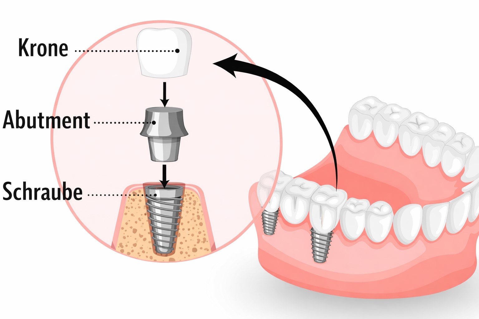 Struktur eines Zahnimplantats 
