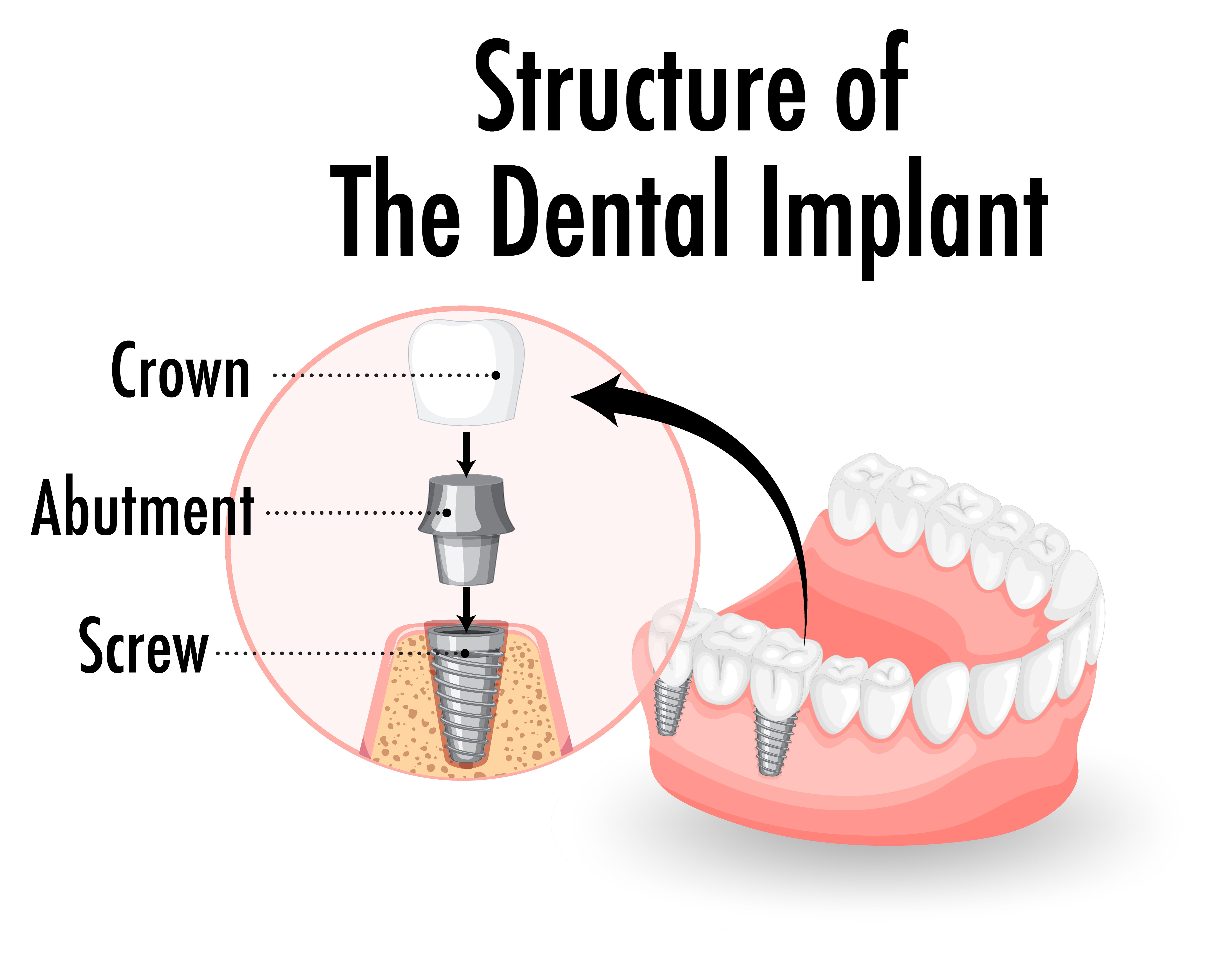Structure of a dental implant 
