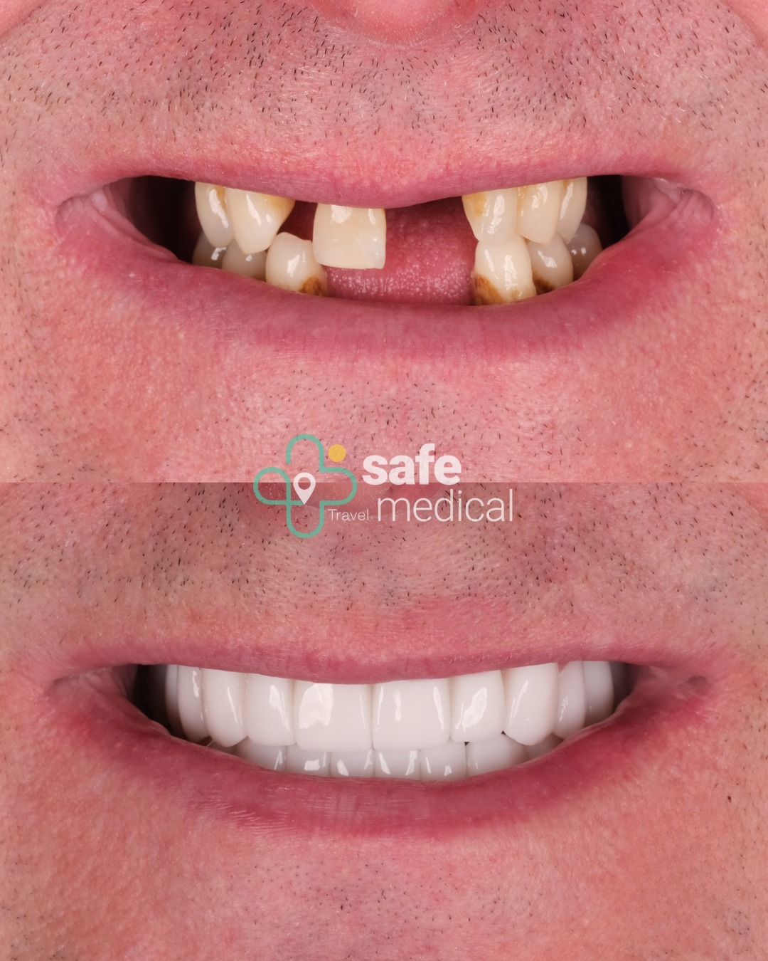 Was ist bei Zahnimplantaten zu erwarten? 