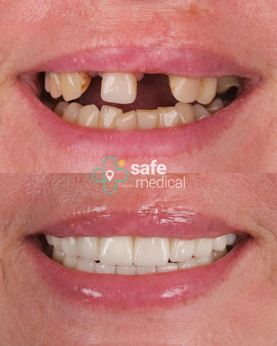 Zahnimplantate vorher nachher in der Türkei 