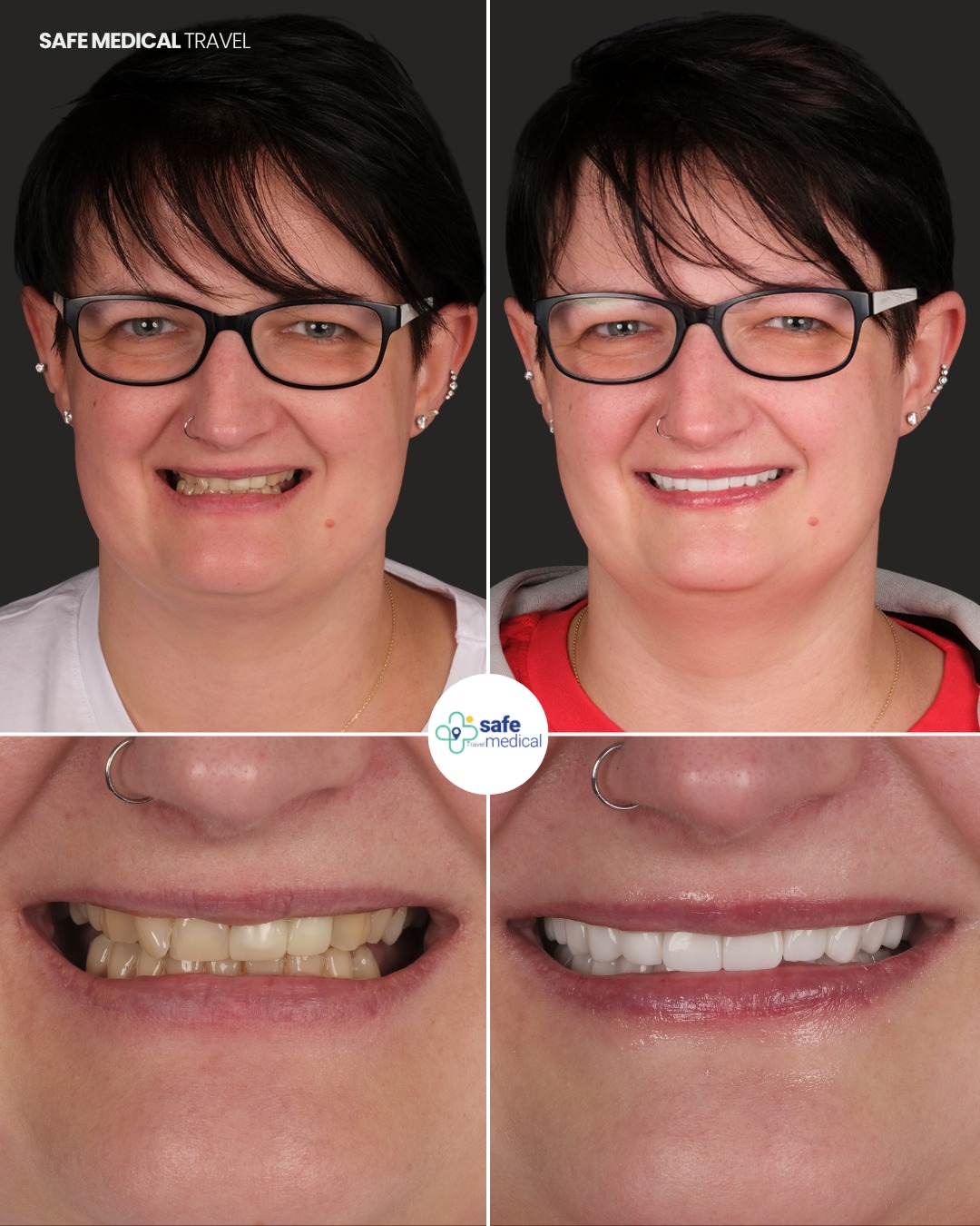 dental-veneer-in-turkey before and after-1