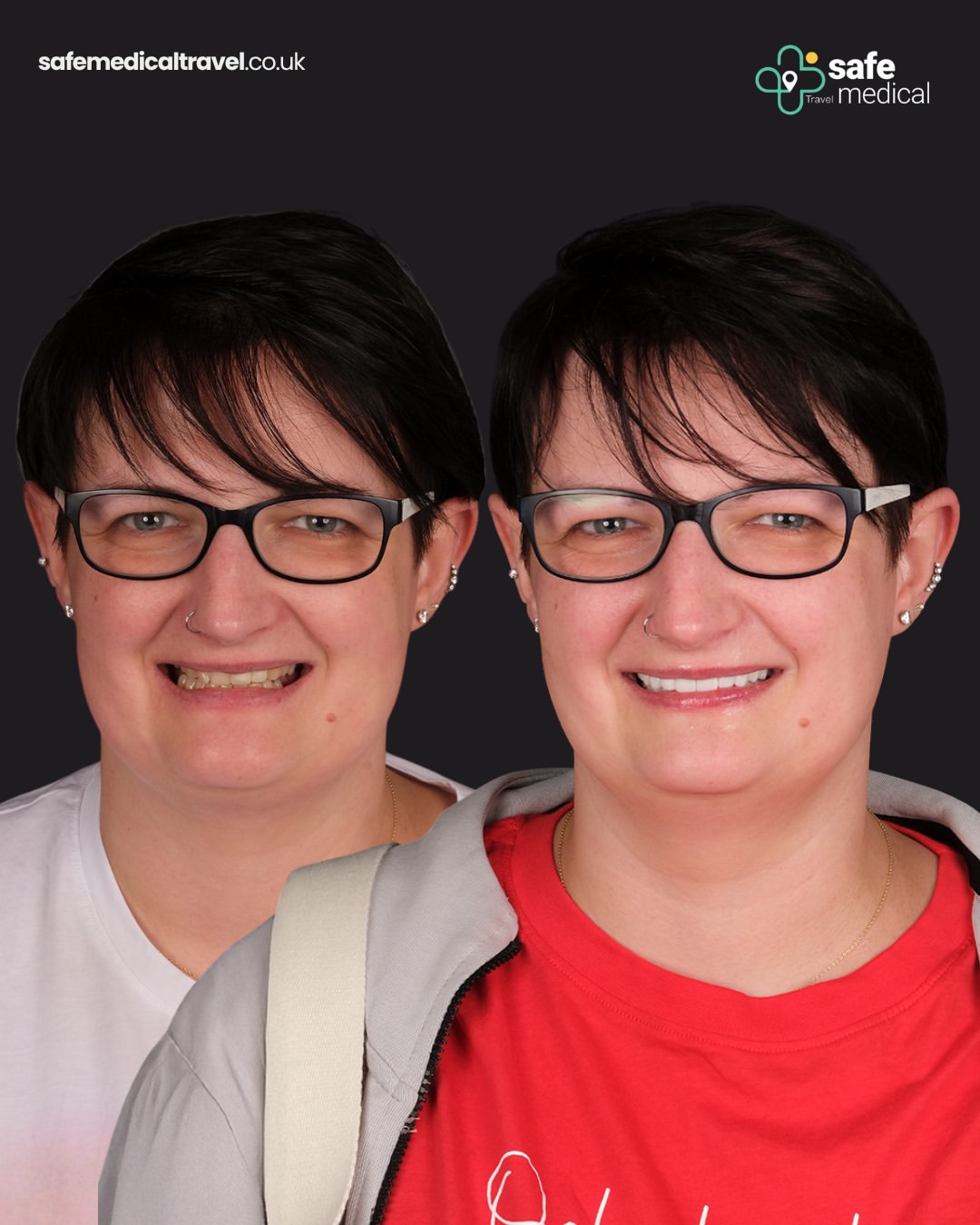 dental-veneer-in-turkey before and after-3