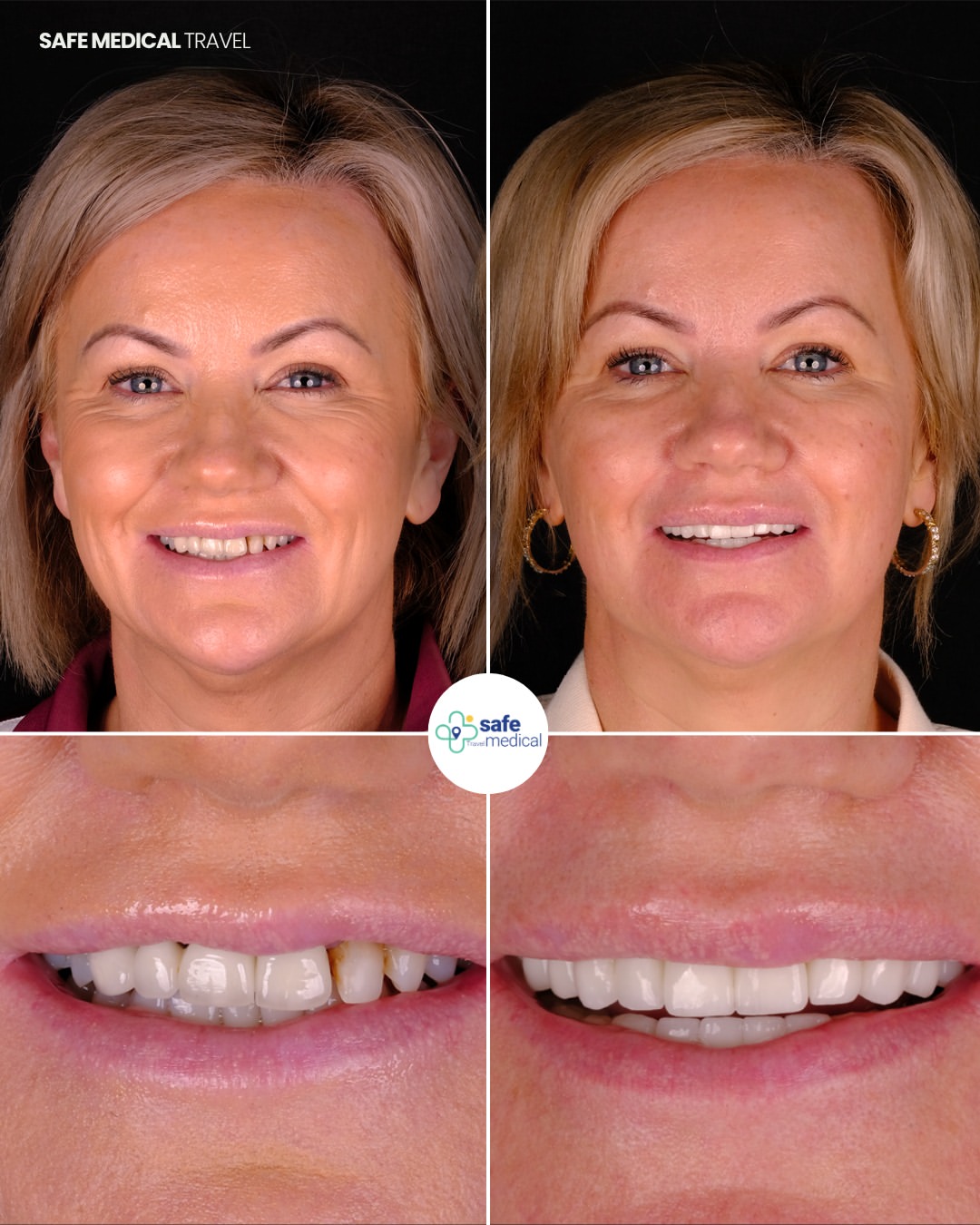 dental-veneer-in-turkey before and after-4