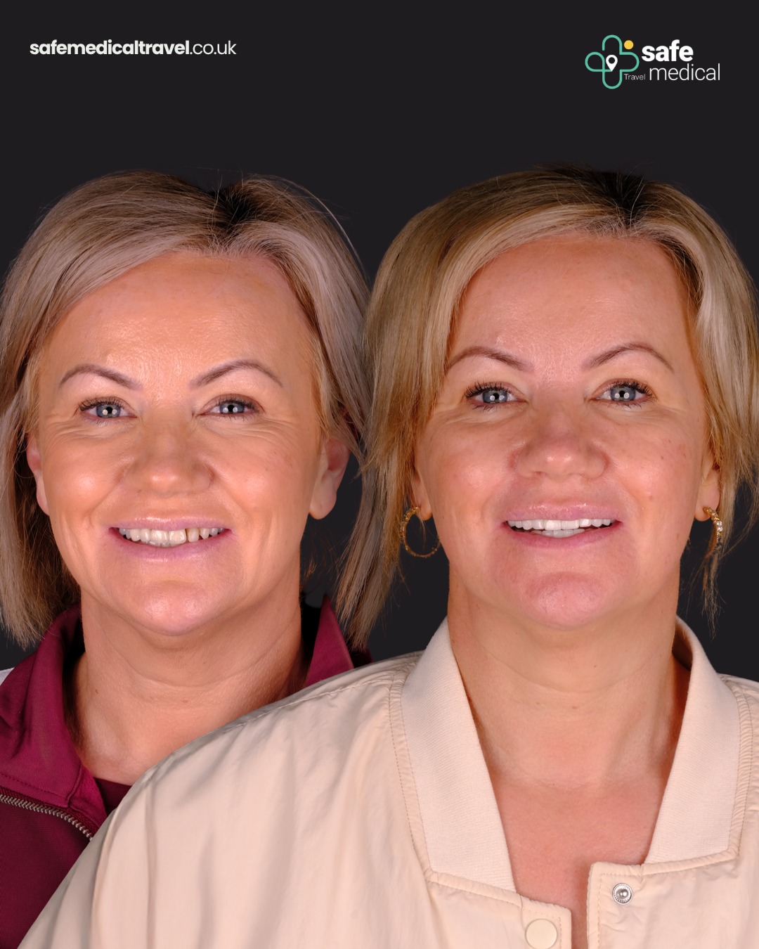 dental-veneer-in-turkey before and after-6