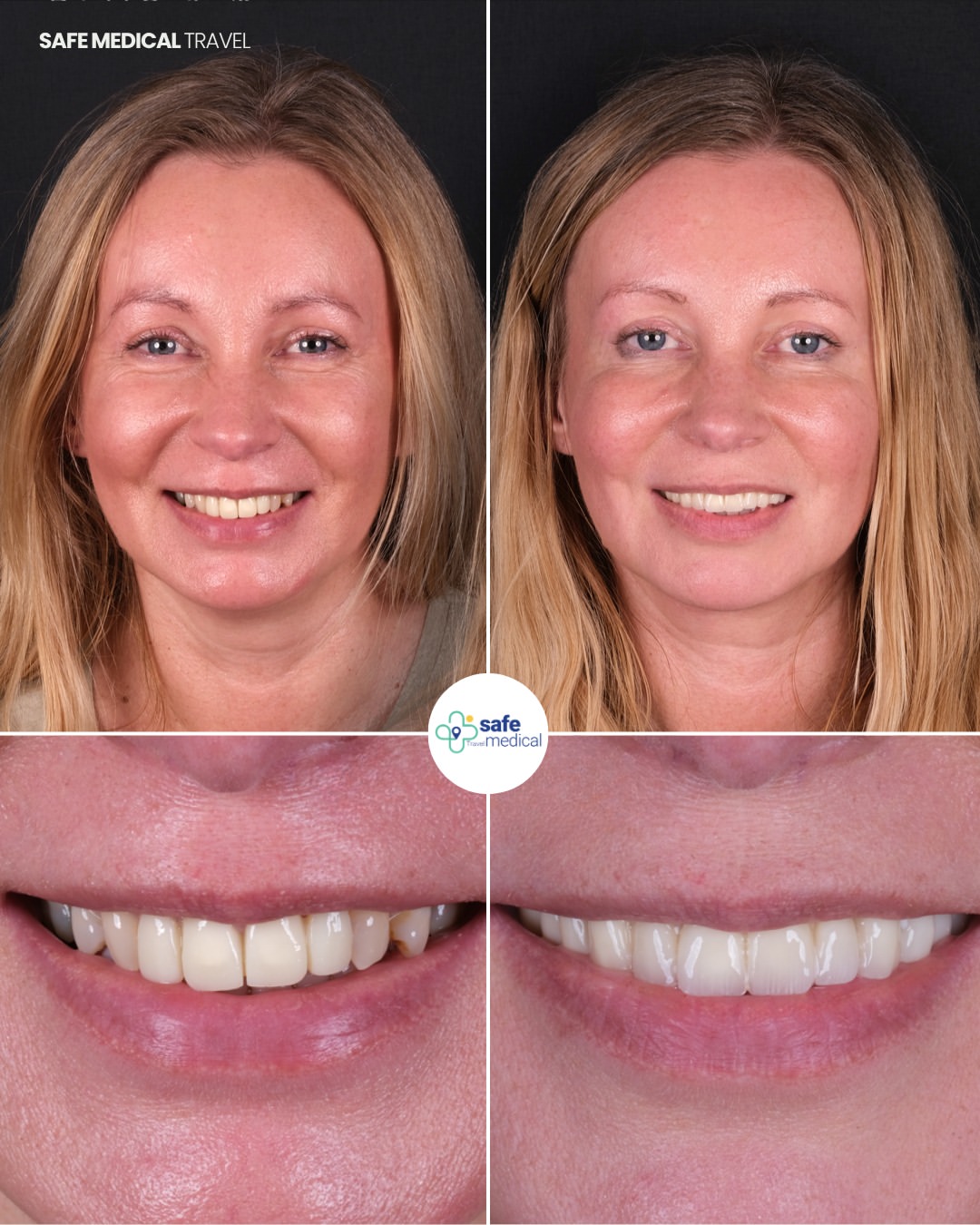 dental-veneer-in-turkey before and after-7