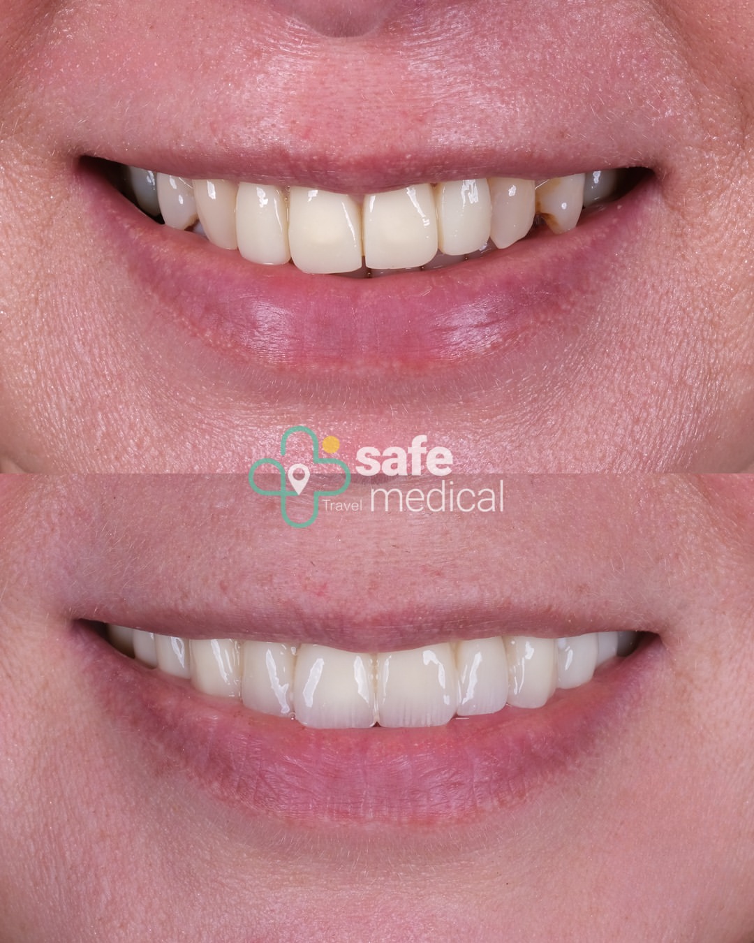 dental-veneer-in-turkey before and after-8