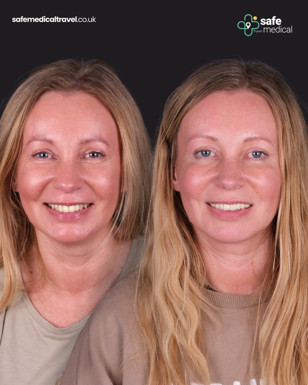 dental-veneer-in-turkey before and after-9
