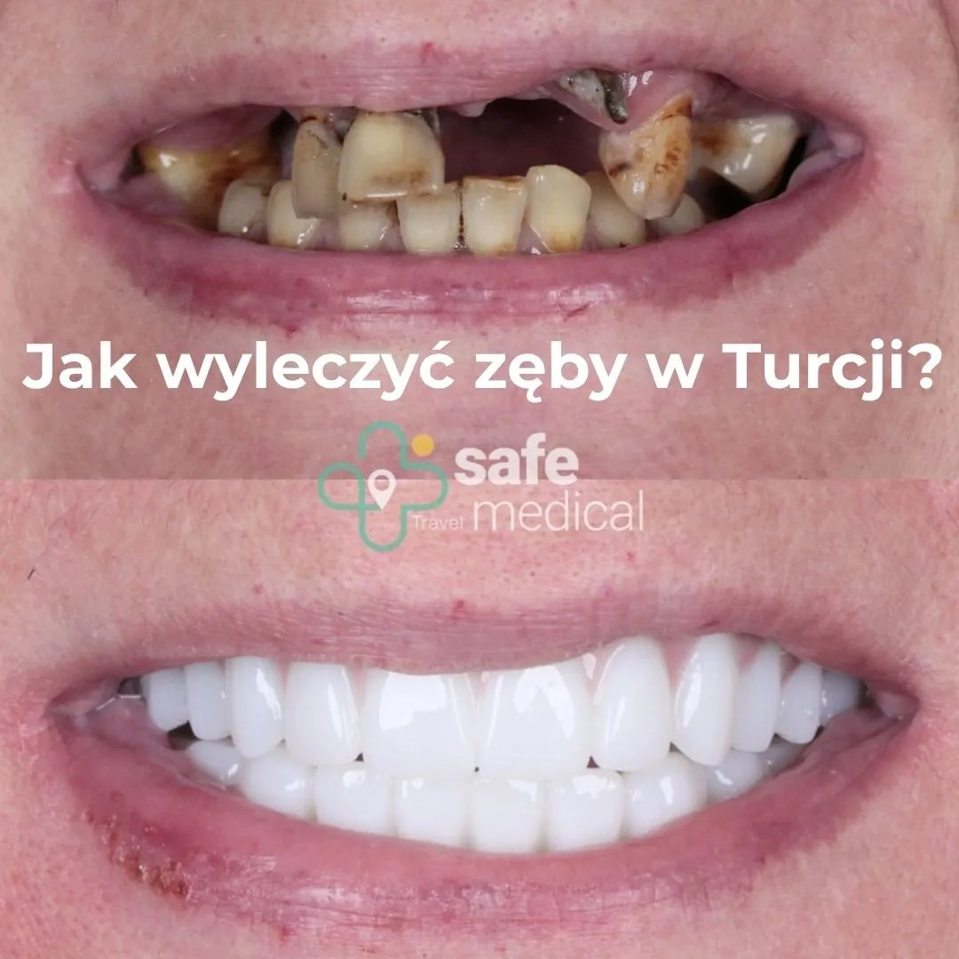 jak-zrobic-zeby-w-turcji