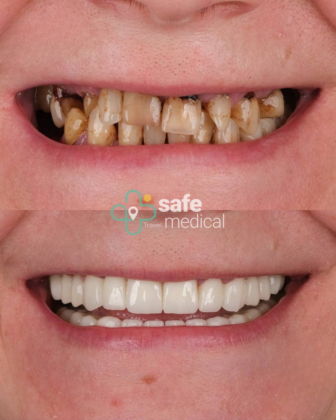  Dental Implants in Turkey 